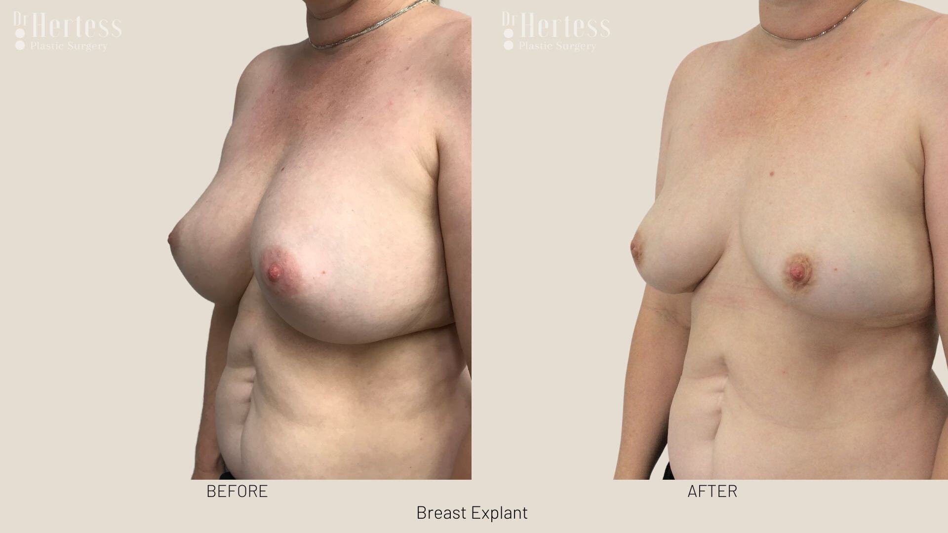 breast implant removal photos