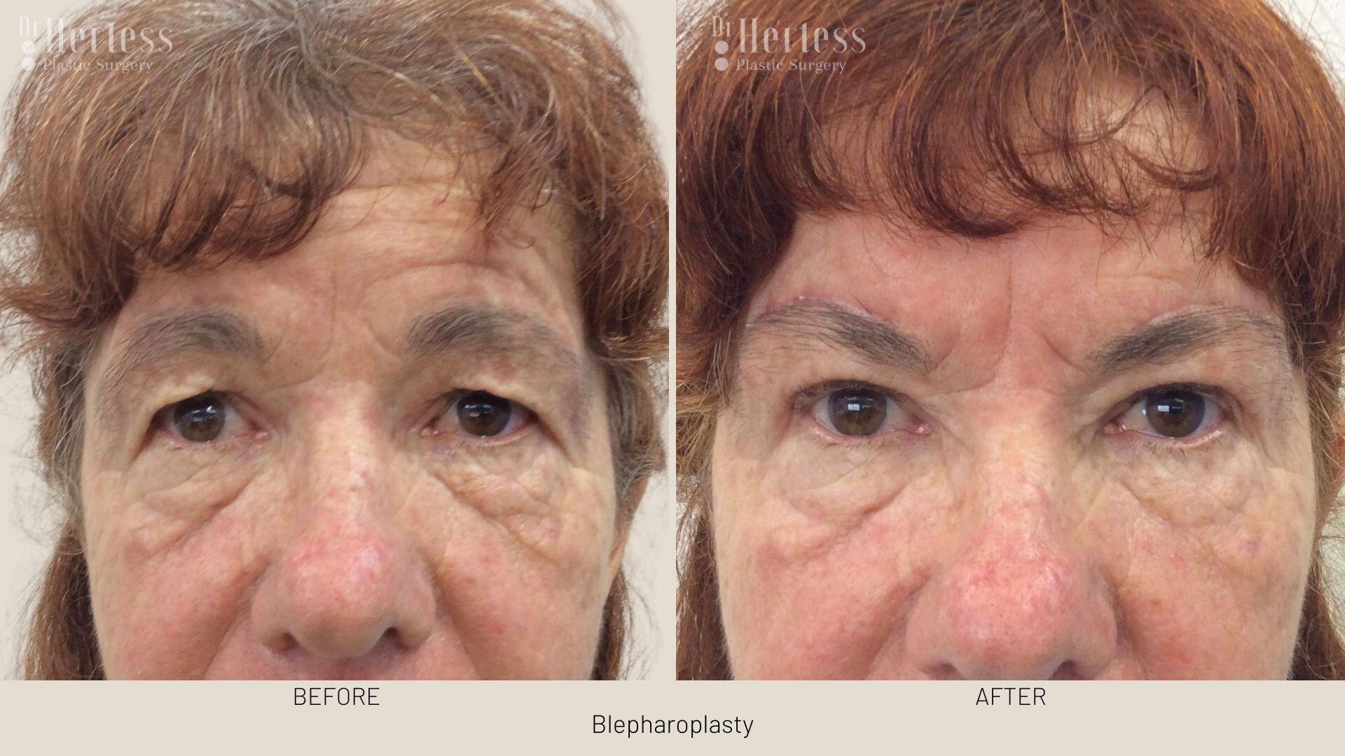 eyelid surgery before and after
