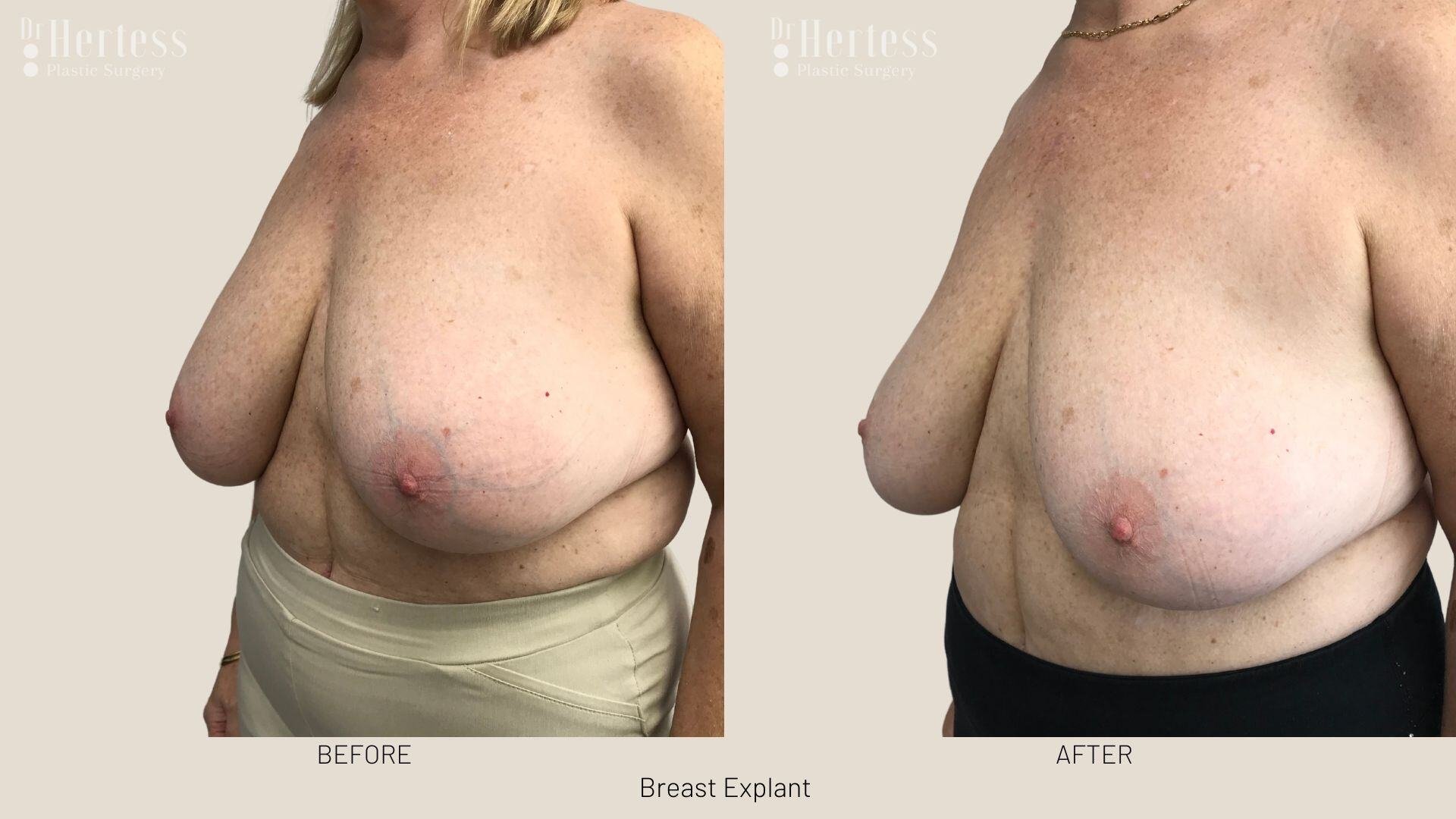 breast implant removal photos