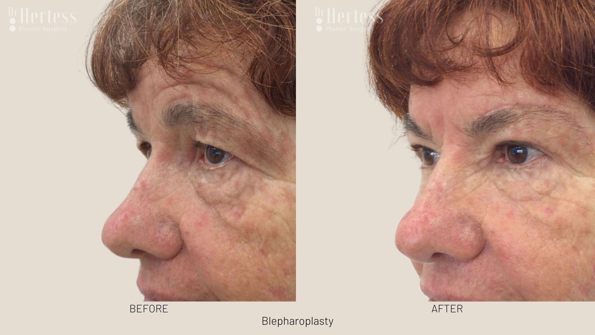 eyelid surgery before and after