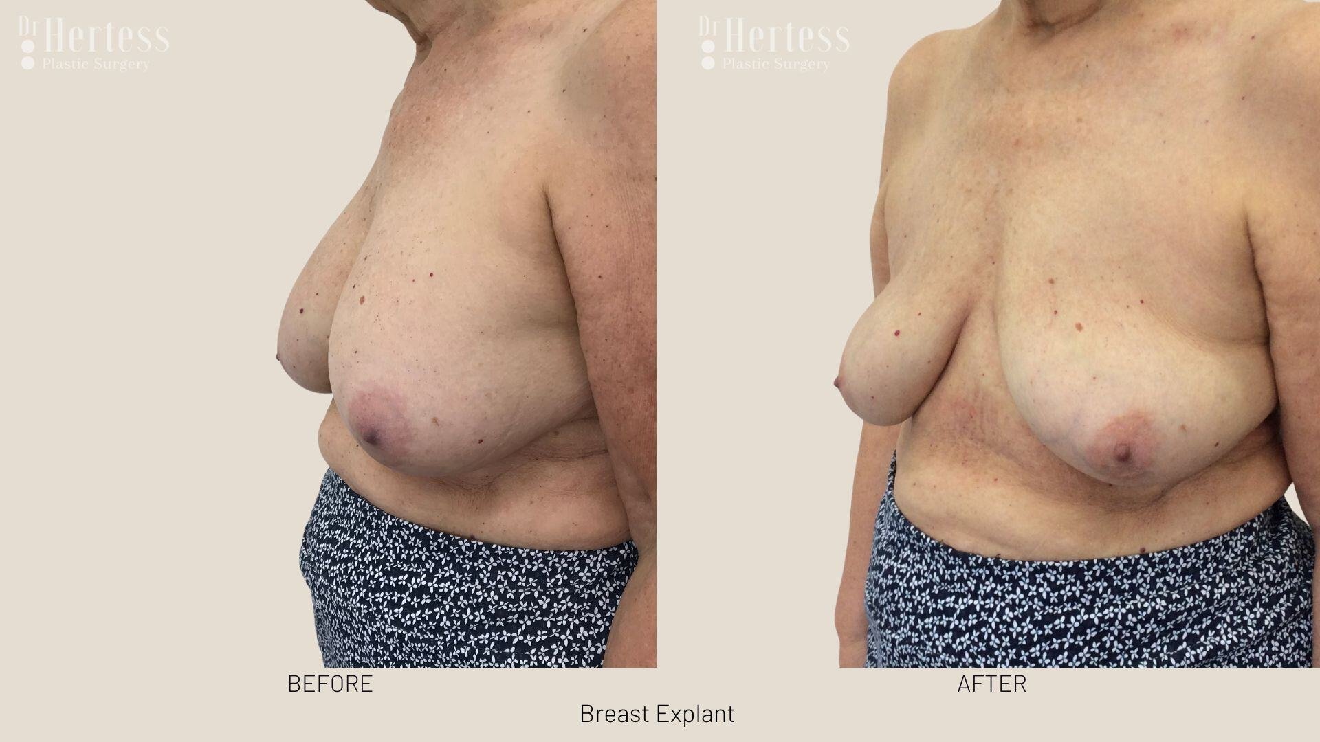 breast implant removal photos