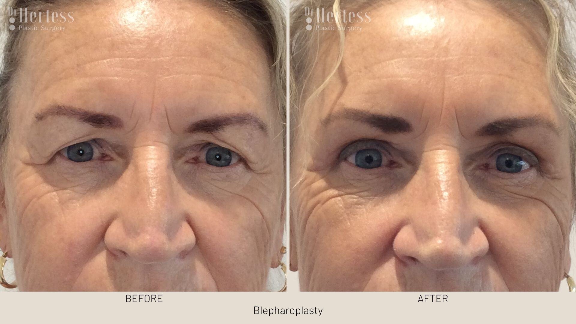eyelid surgery before and after