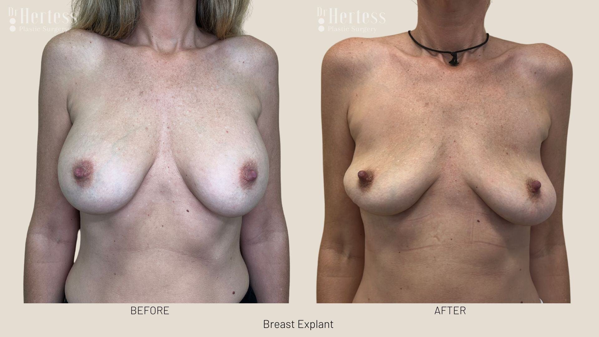 breast implant removal photos