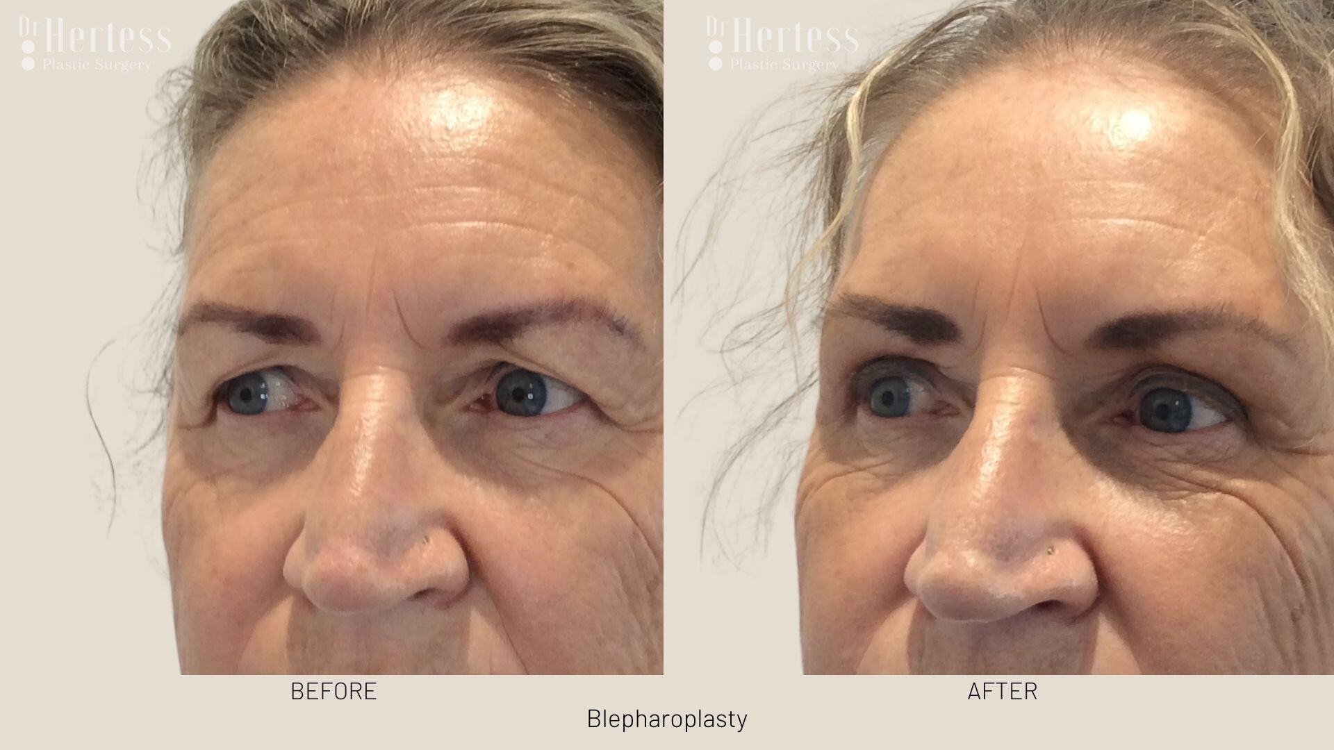 eyelid surgery before and after