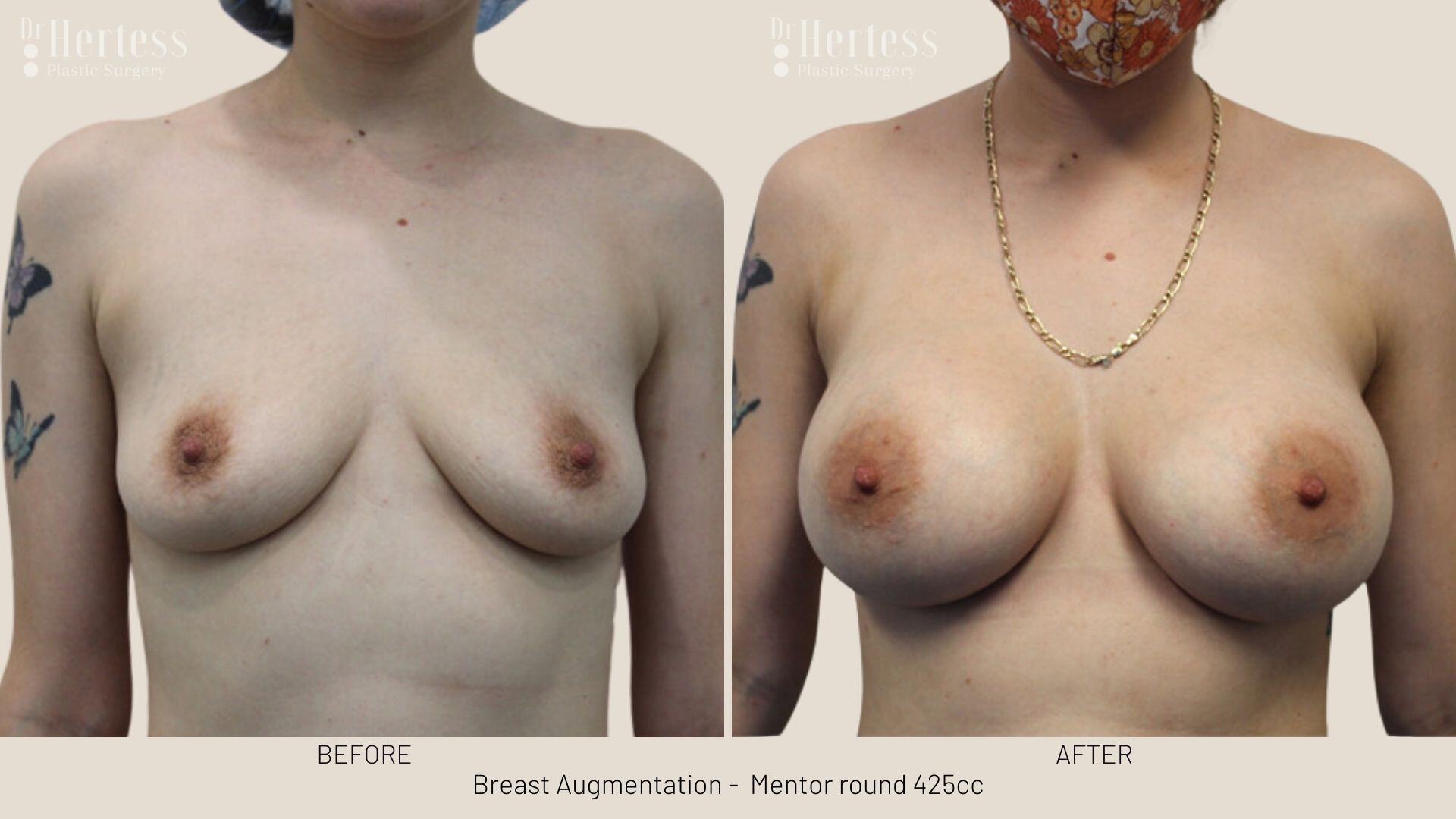 boob job photos before and after