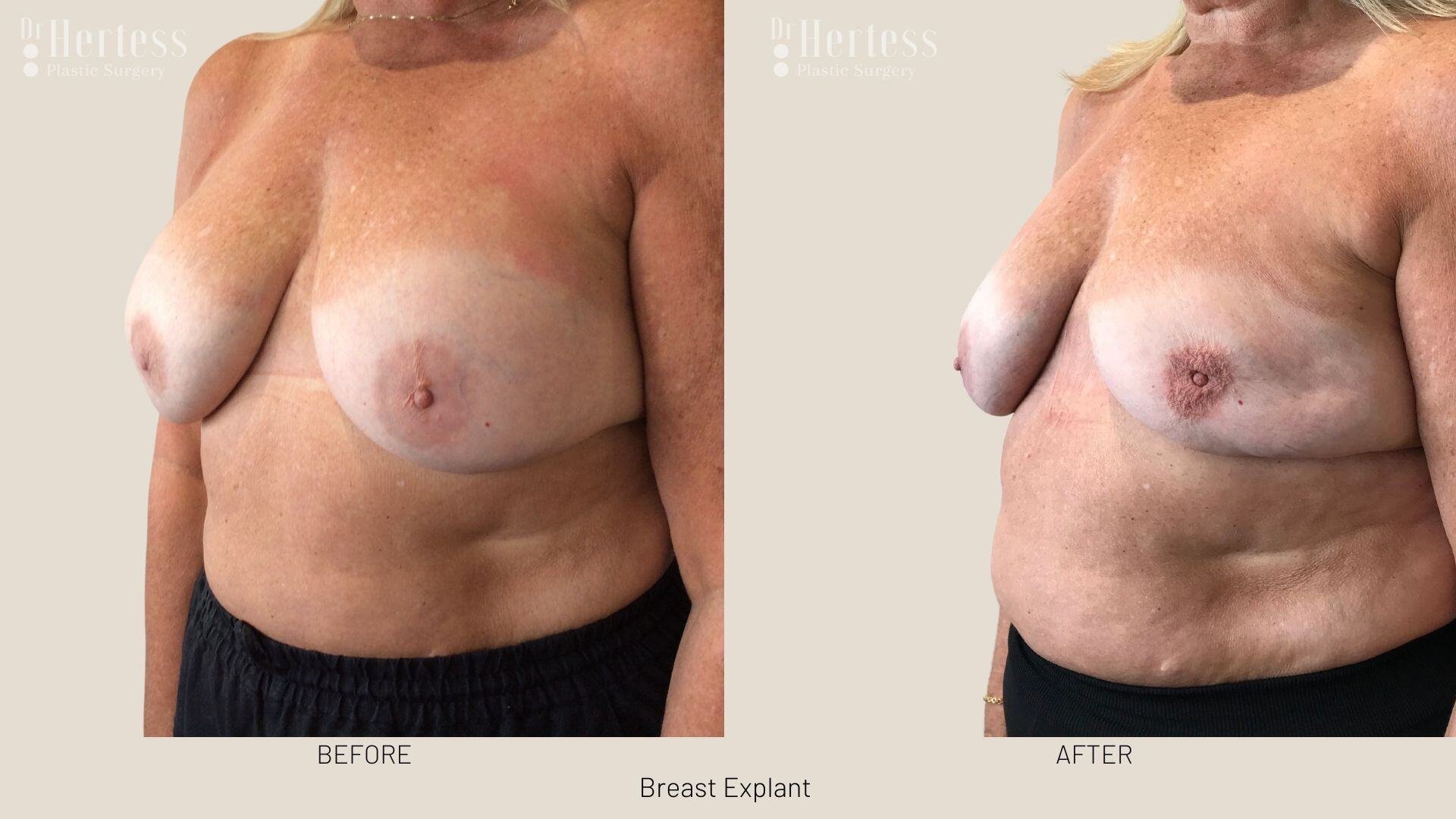 breast implant removal photos