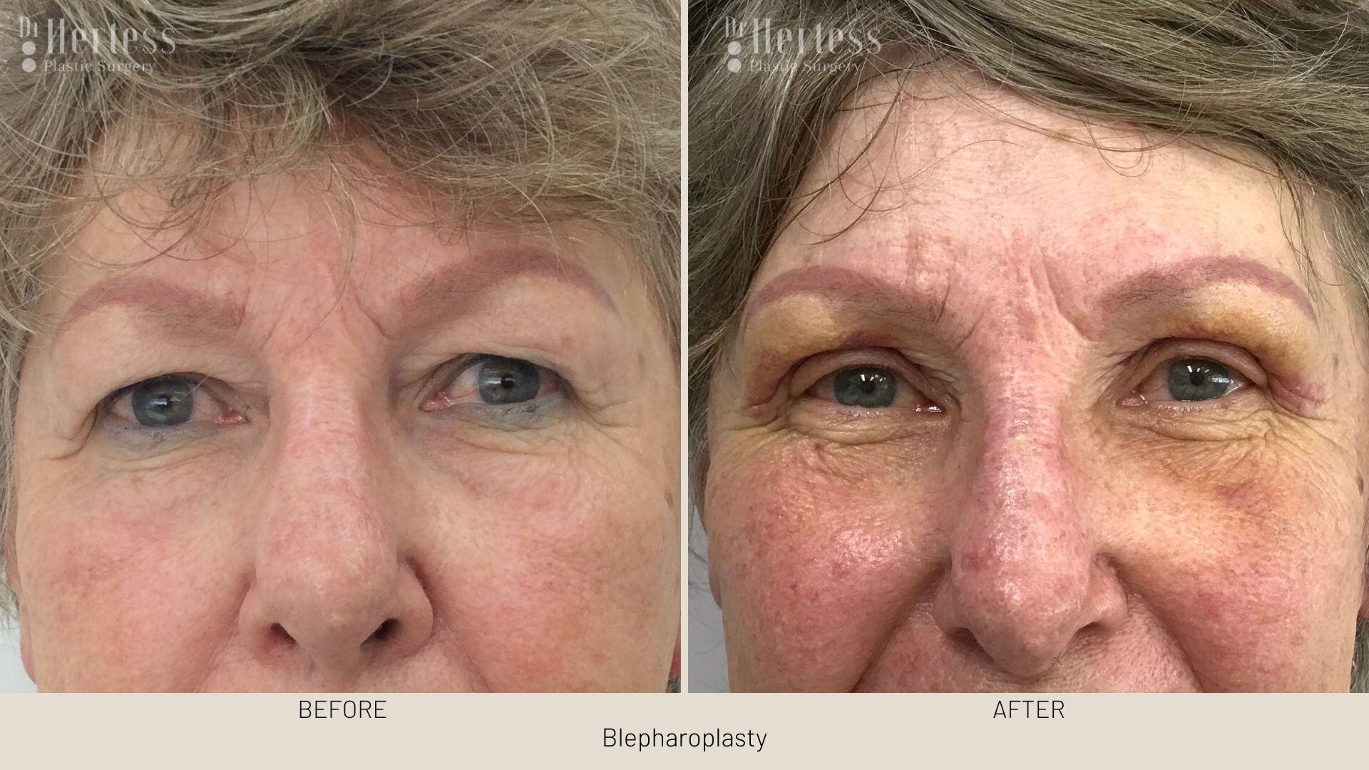 eyelid surgery before and after