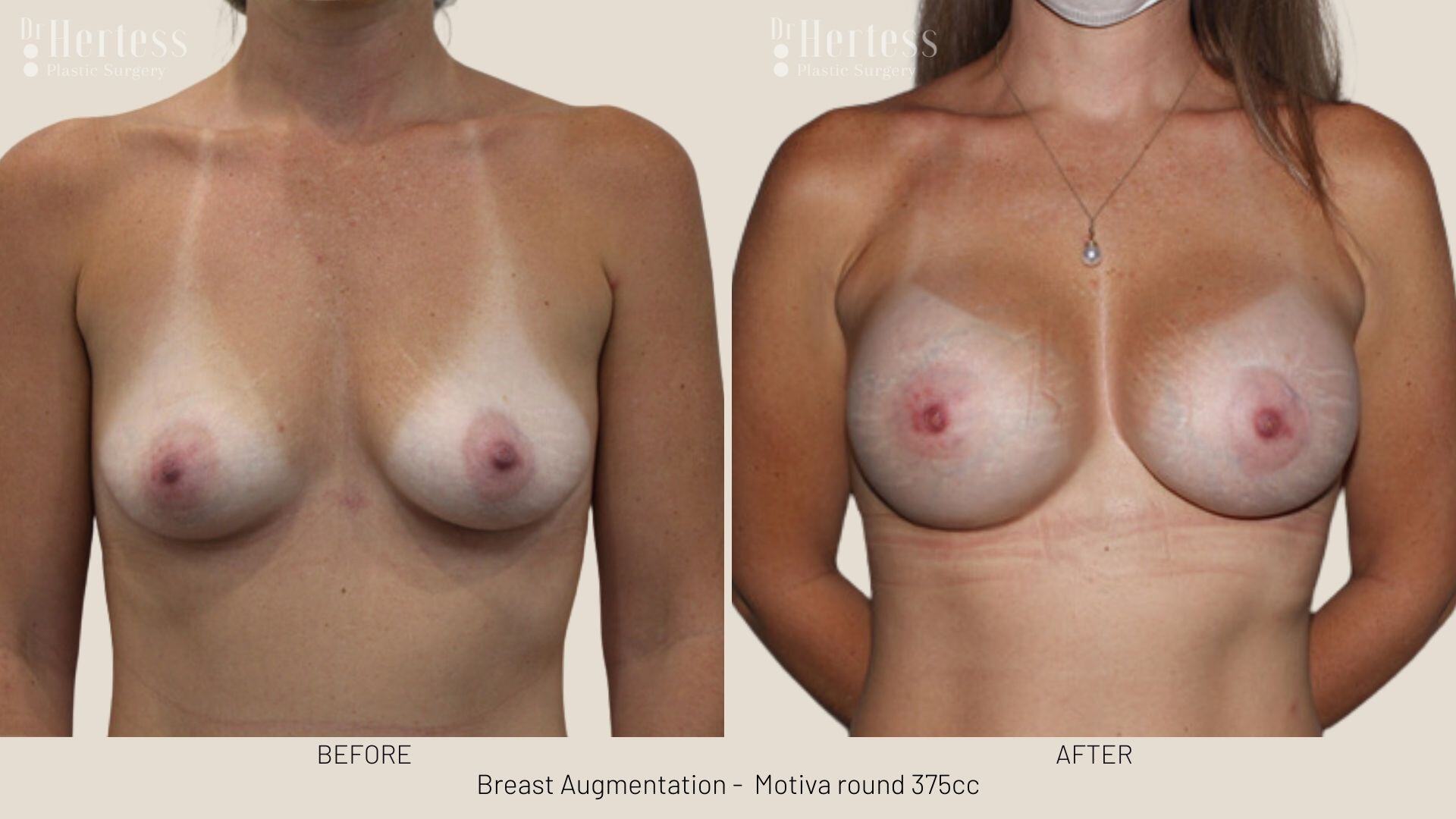boob job photos before and after
