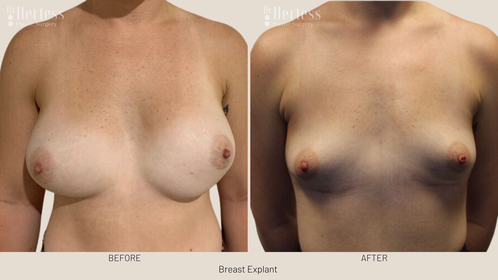 breast implant removal photos
