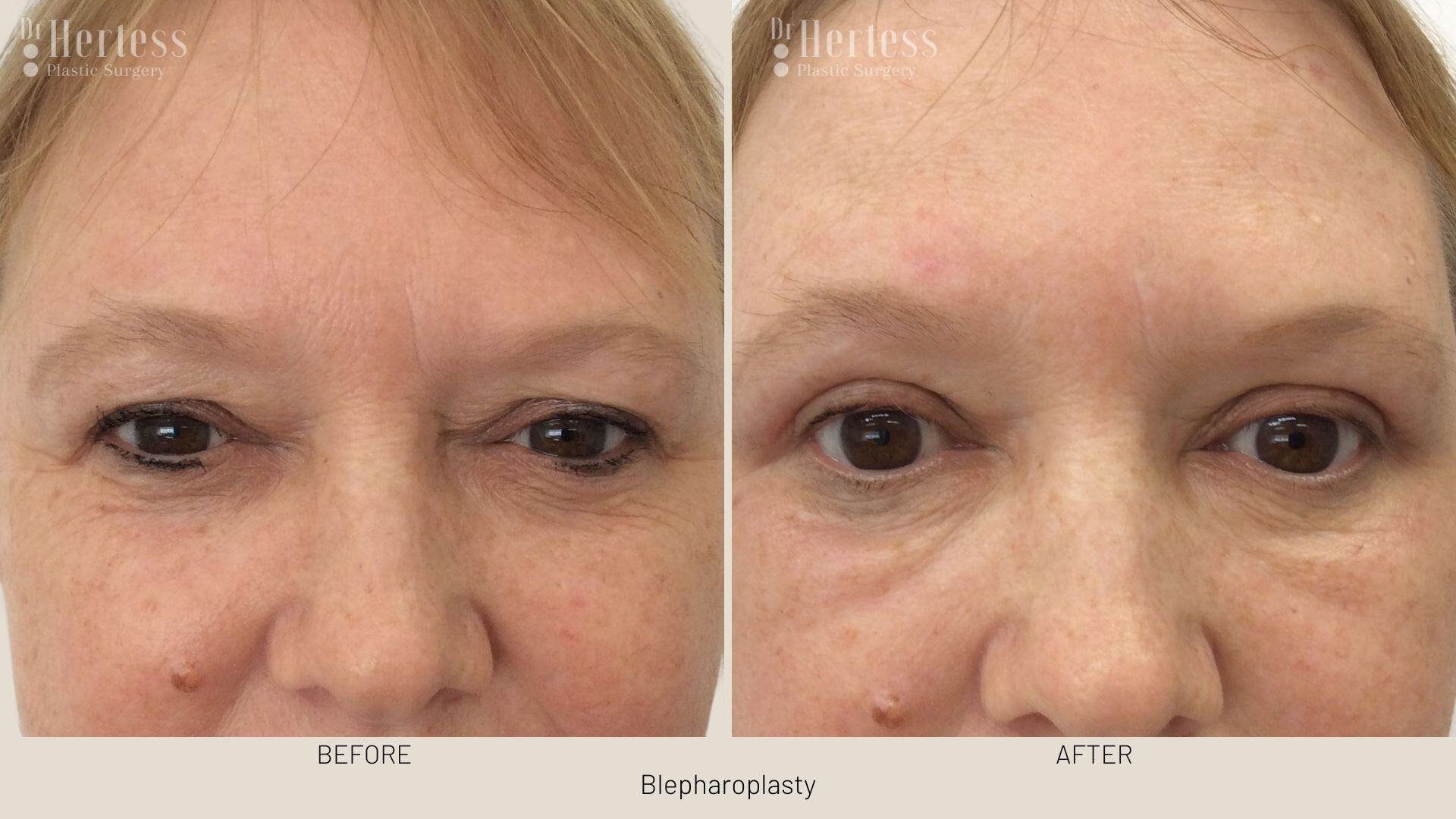 eyelid surgery before and after