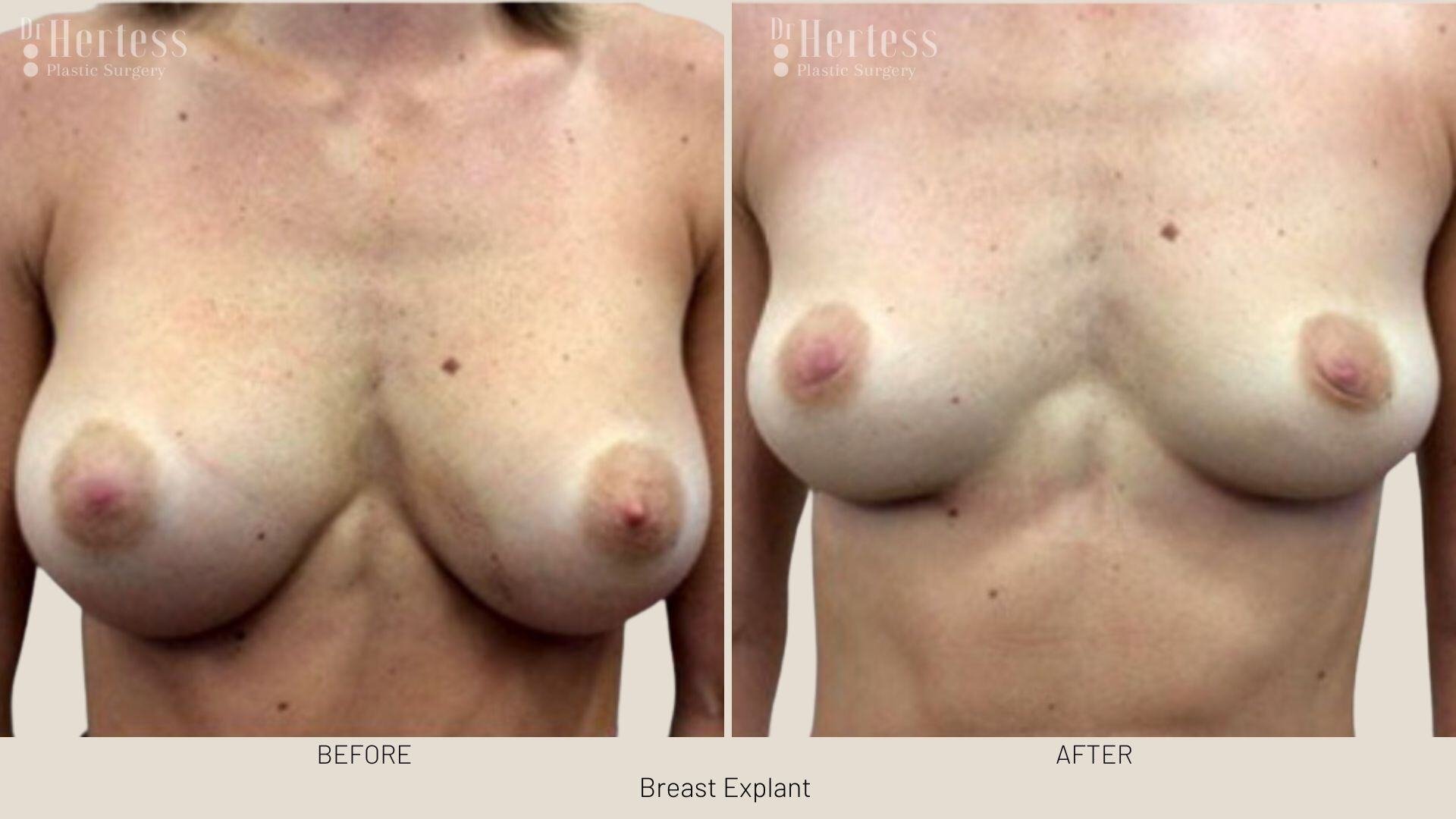 breast implant removal photos