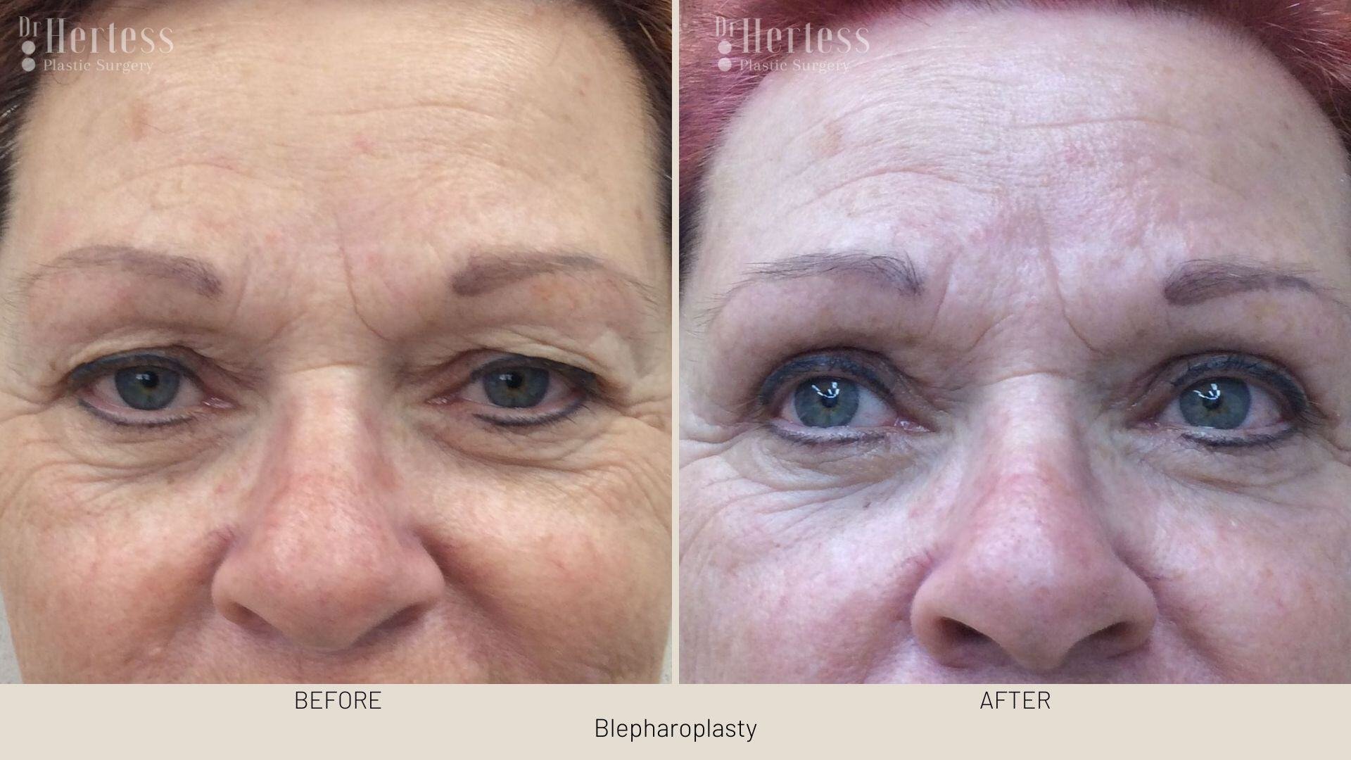 eyelid surgery before and after