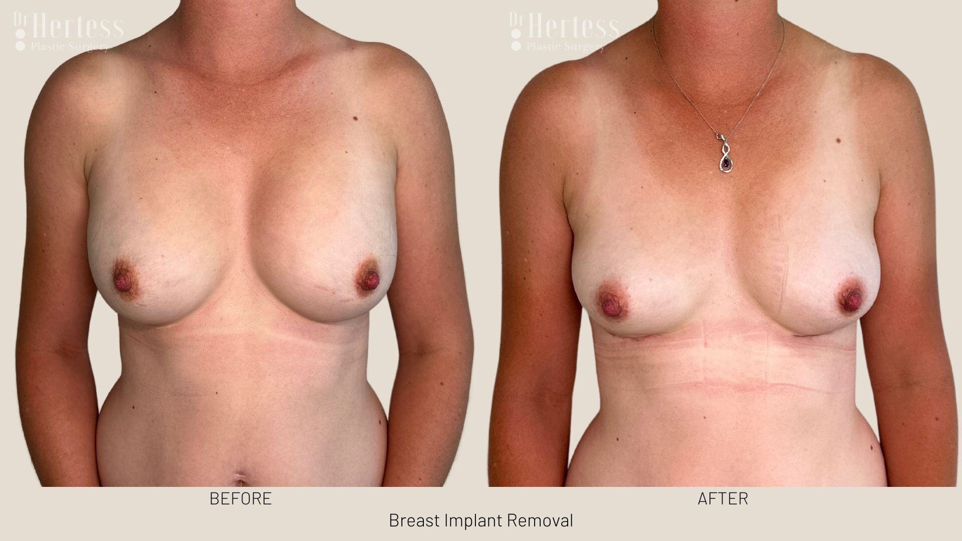 breast implant removal photos