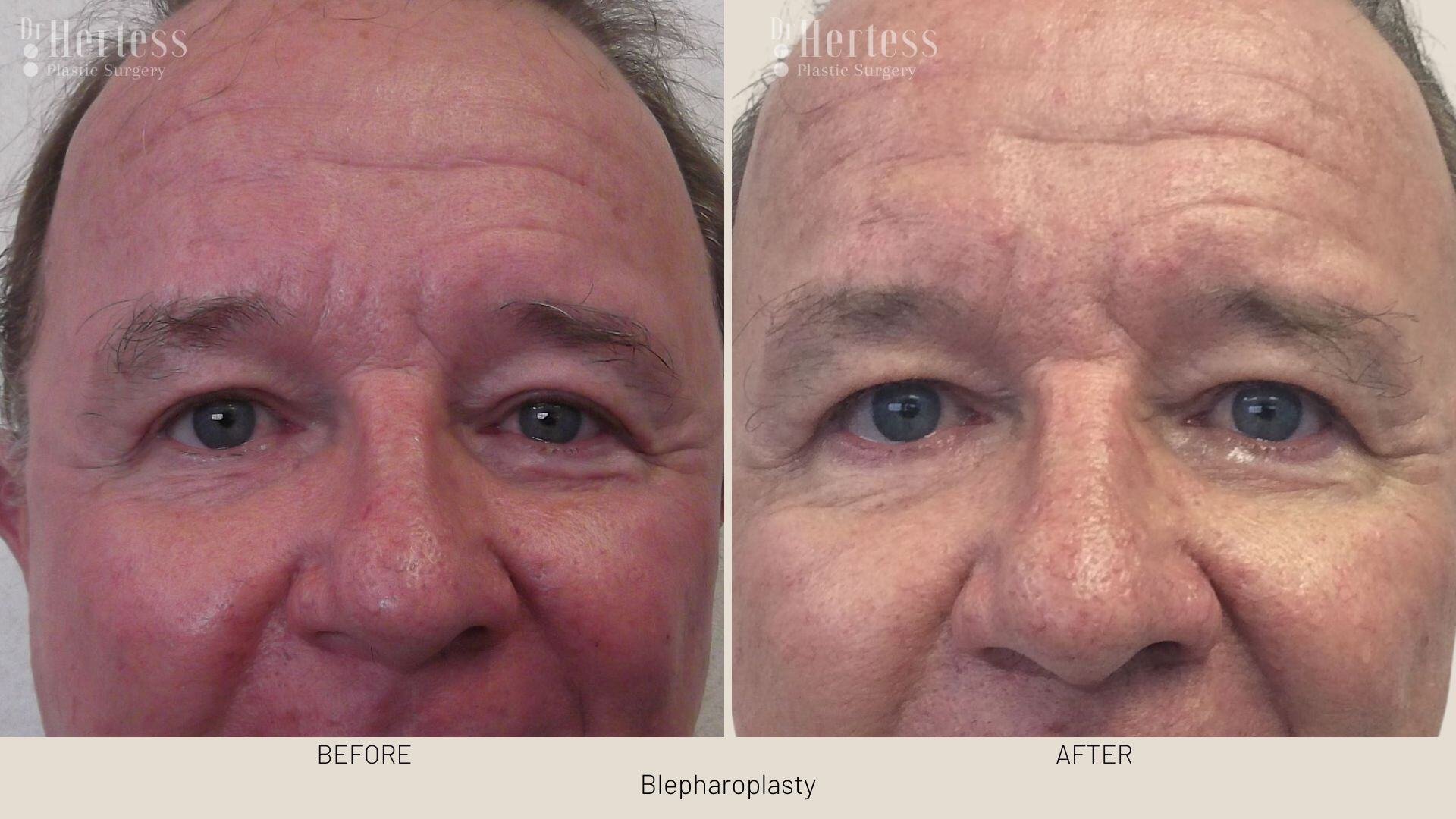 eyelid surgery before and after