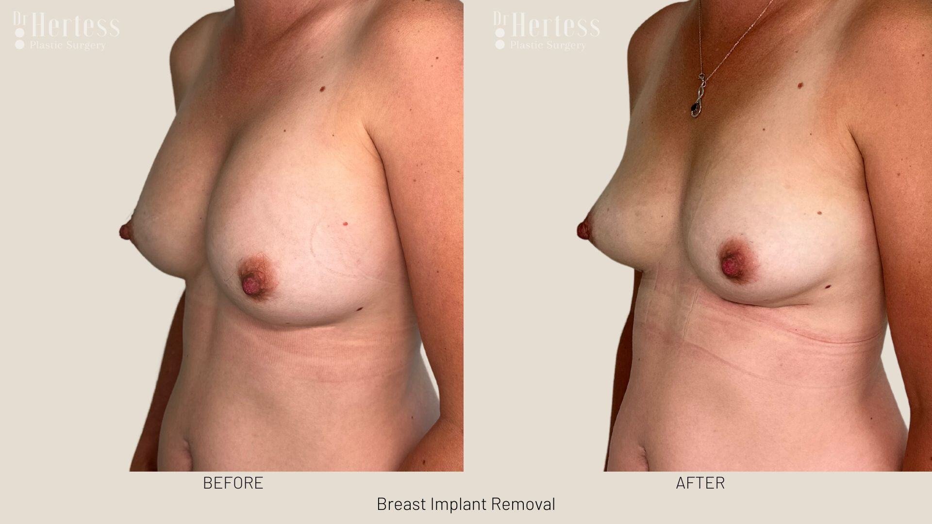 breast implant removal photos