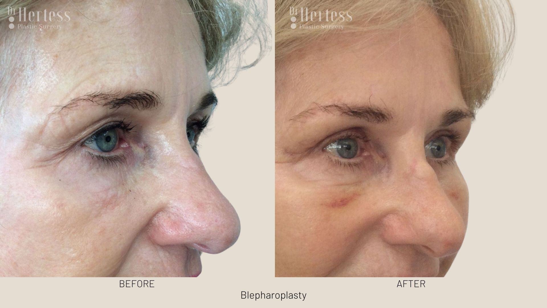 eyelid surgery before and after