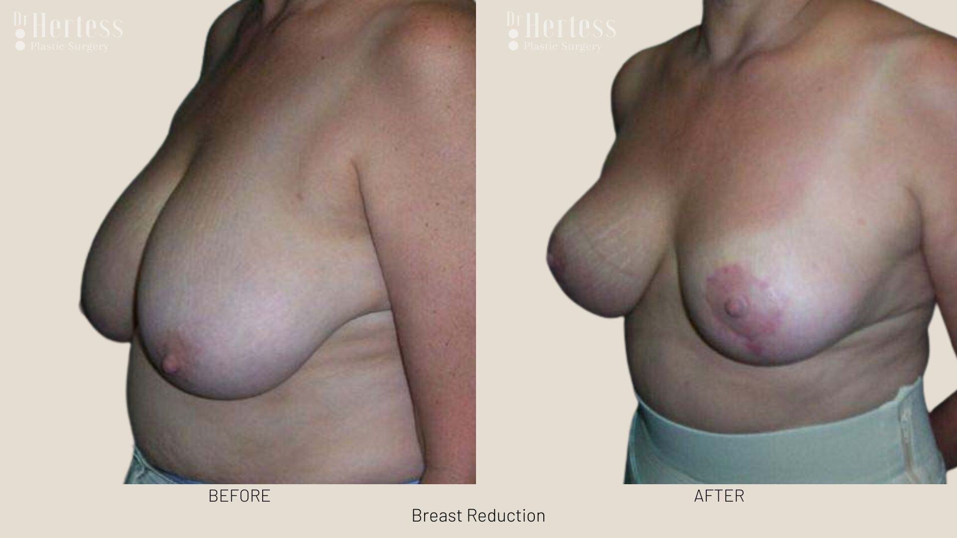 breast reduction before and after