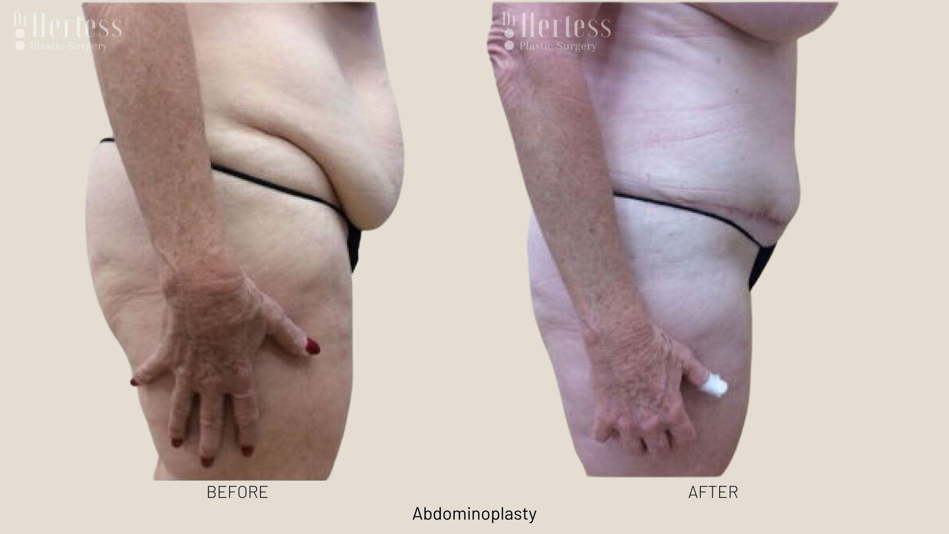 abdominoplasty before and after photos