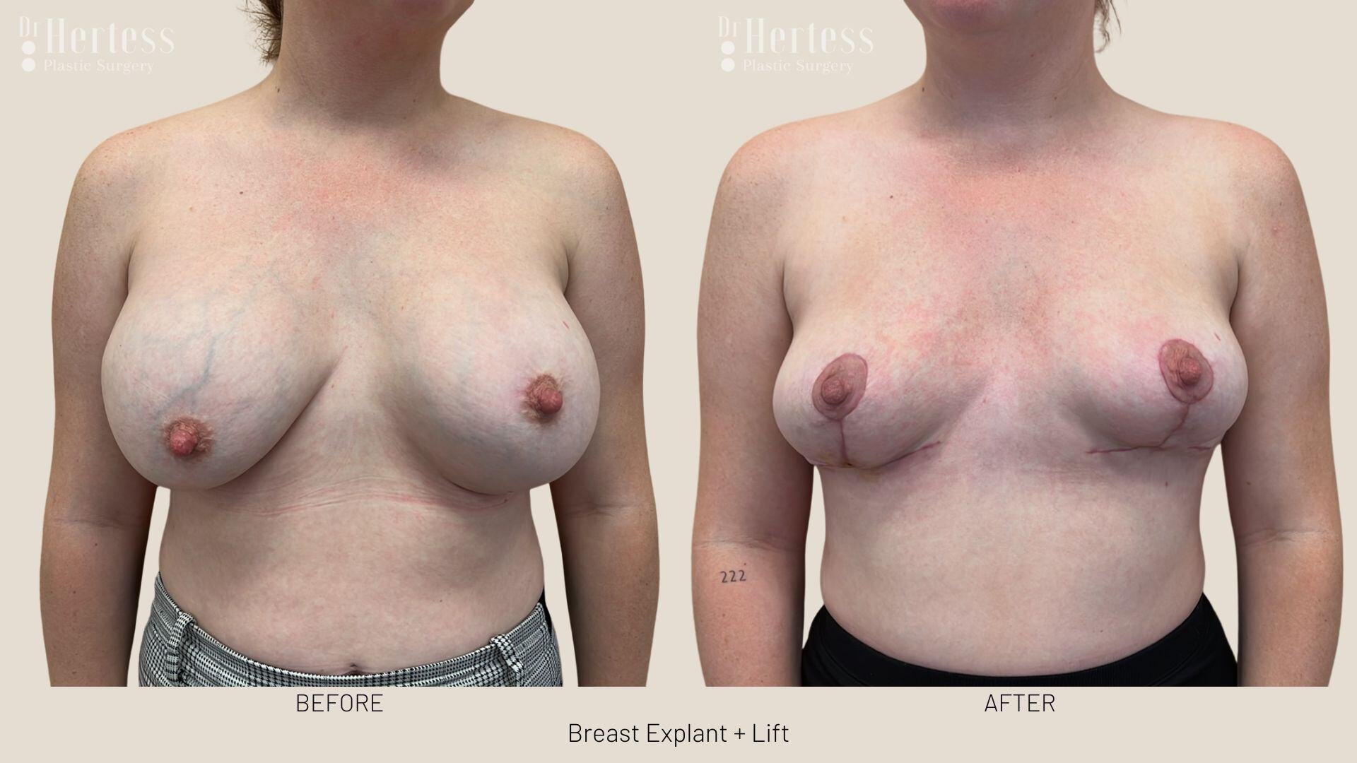 breast explant and lift photos