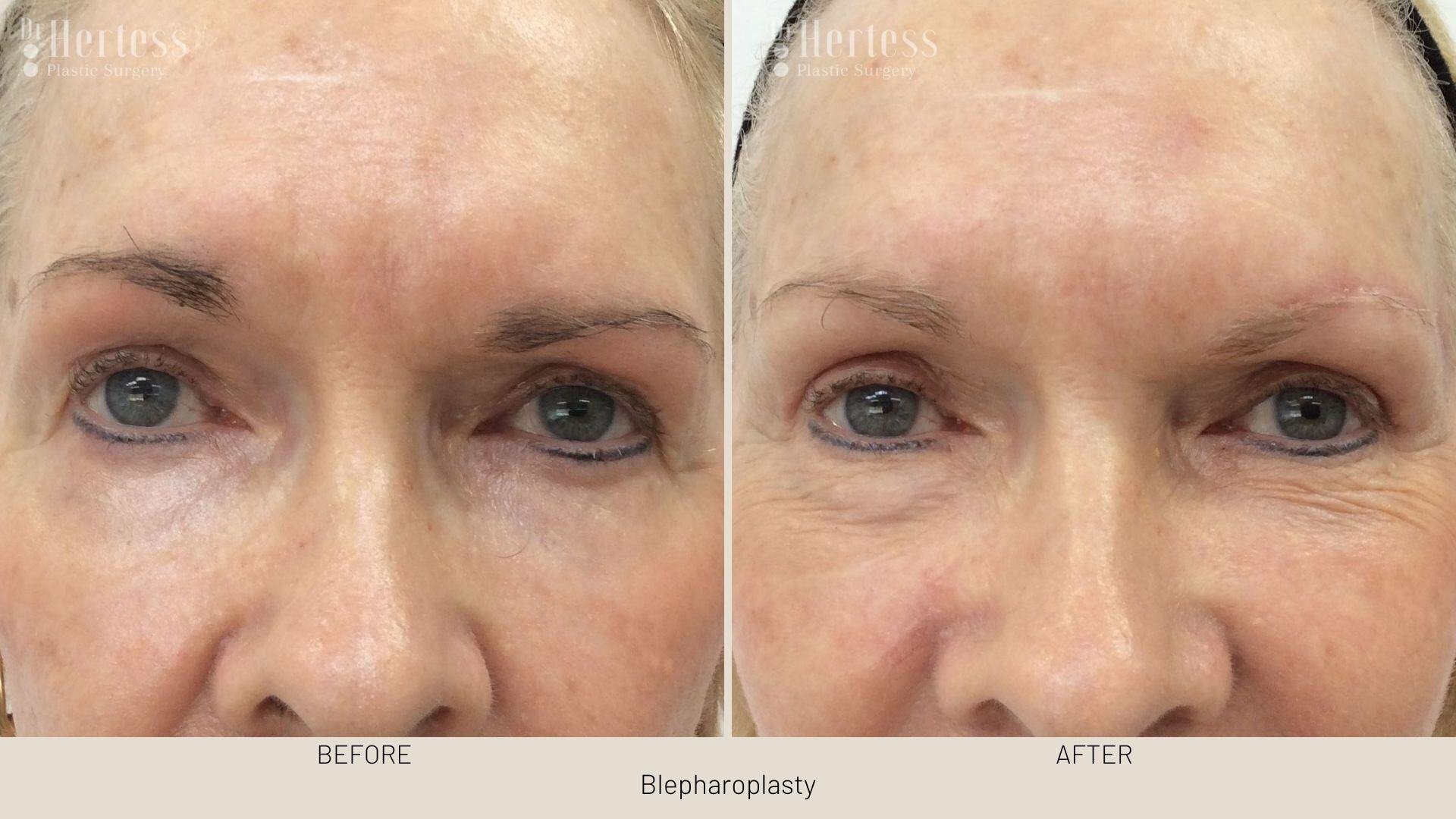 eyelid surgery before and after