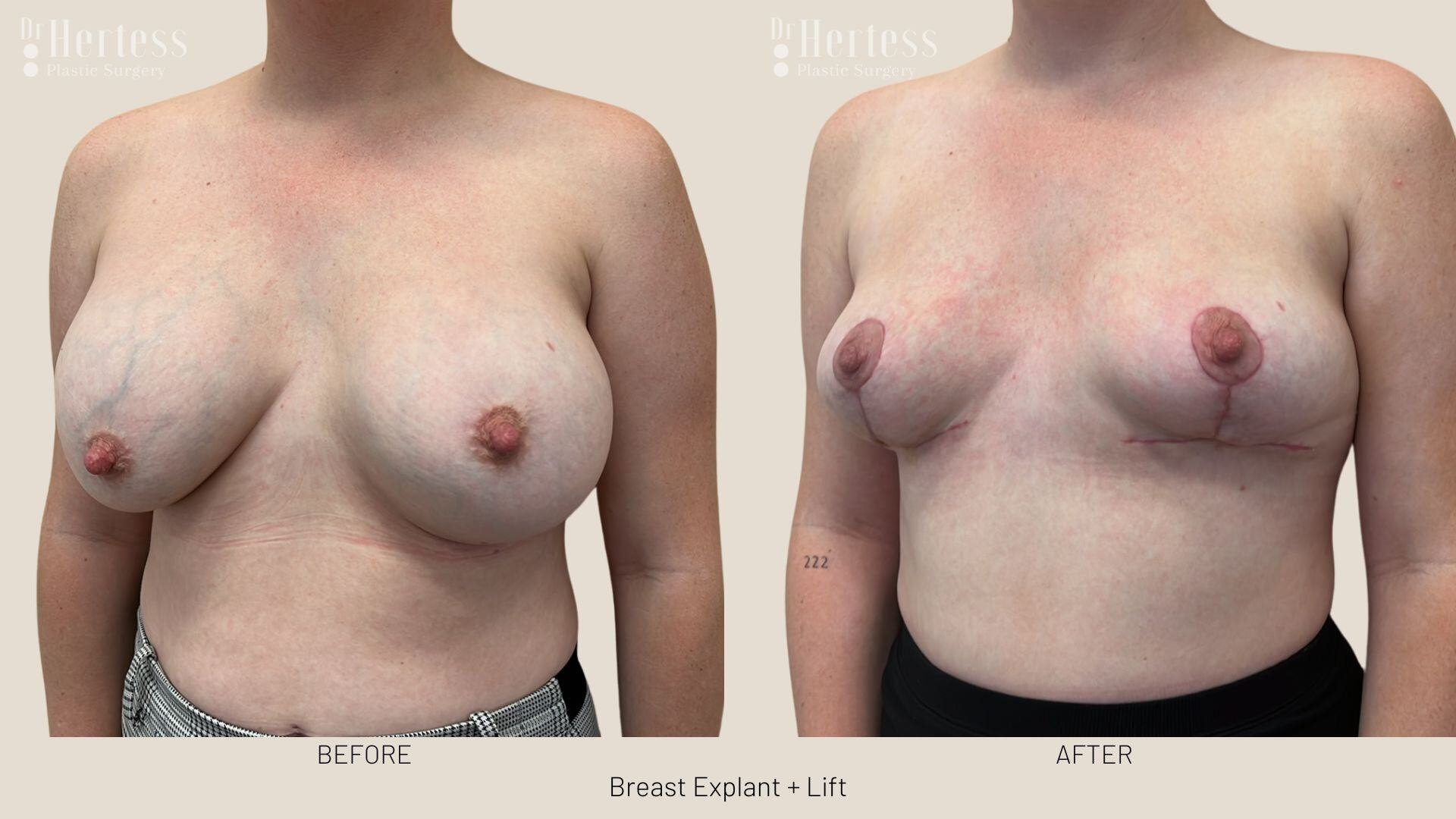 breast explant and lift photos