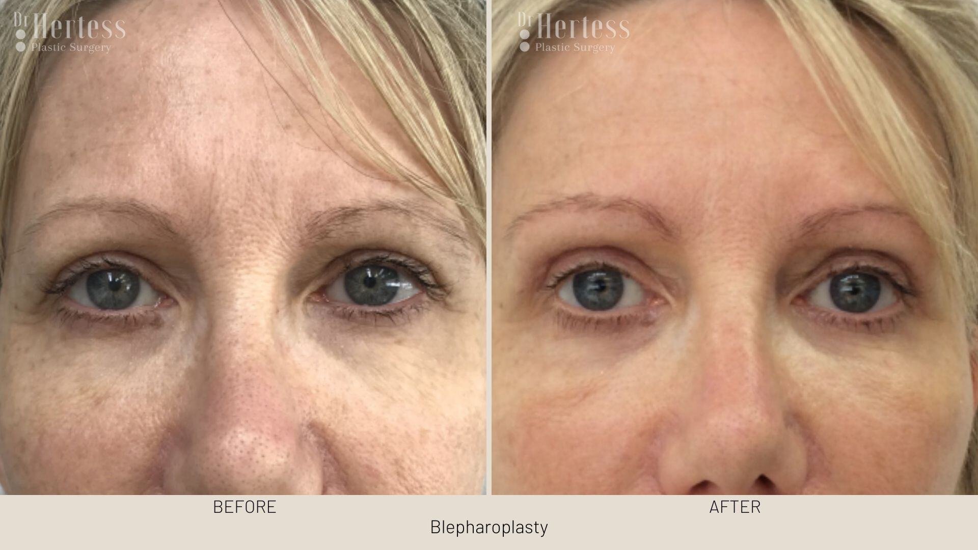 eyelid surgery before and after