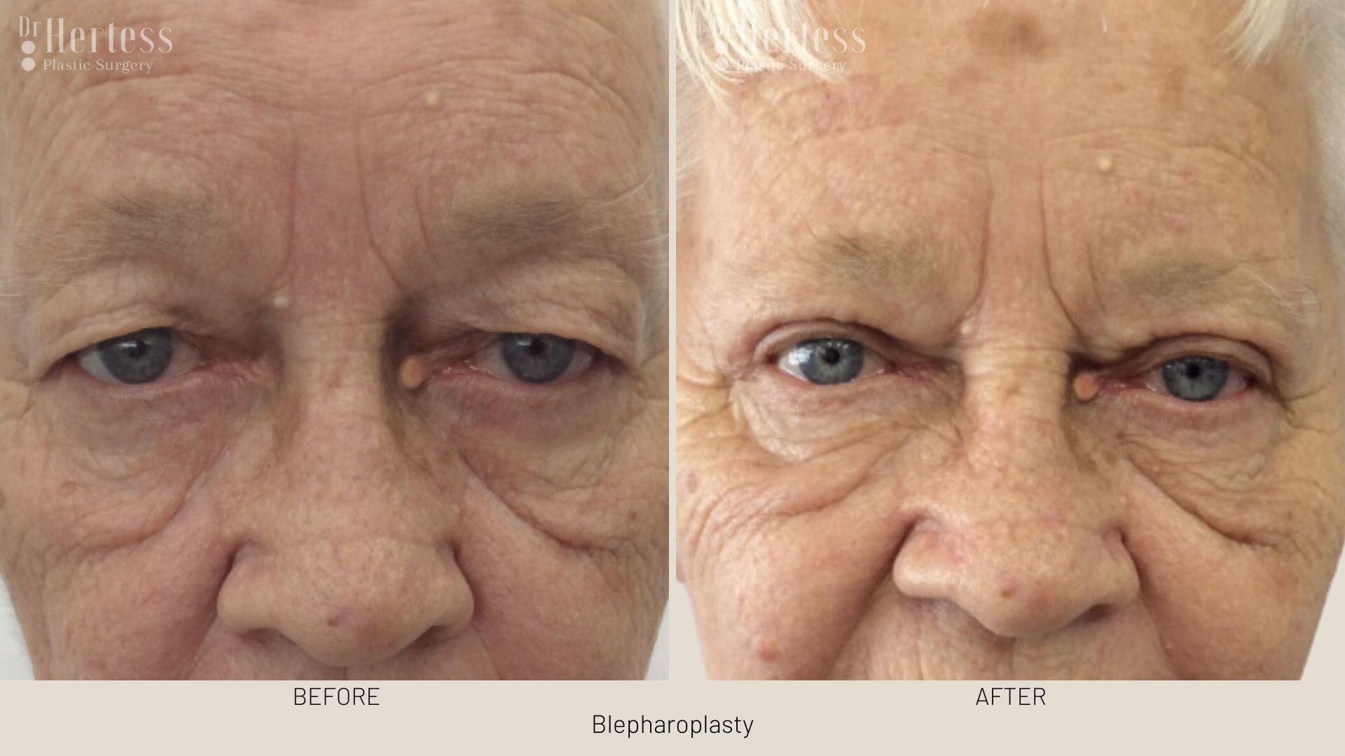 eyelid surgery before and after