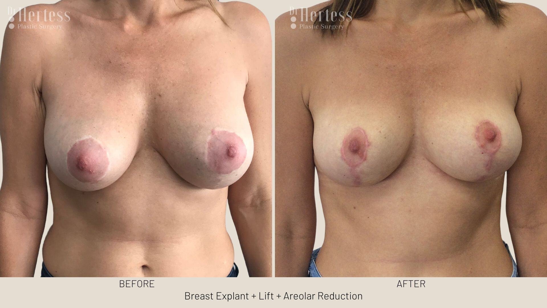 breast explant and lift photos