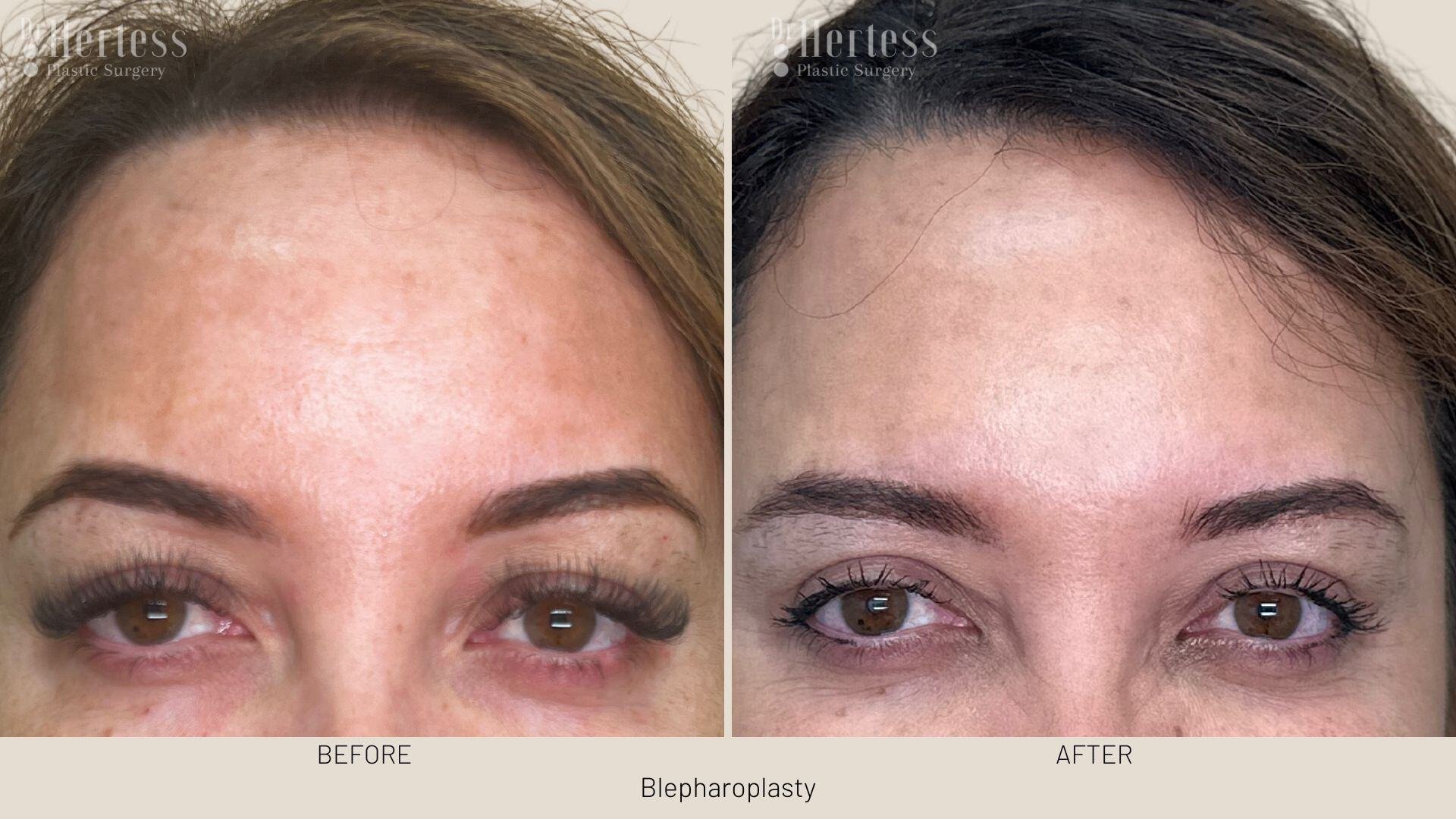 eyelid surgery before and after