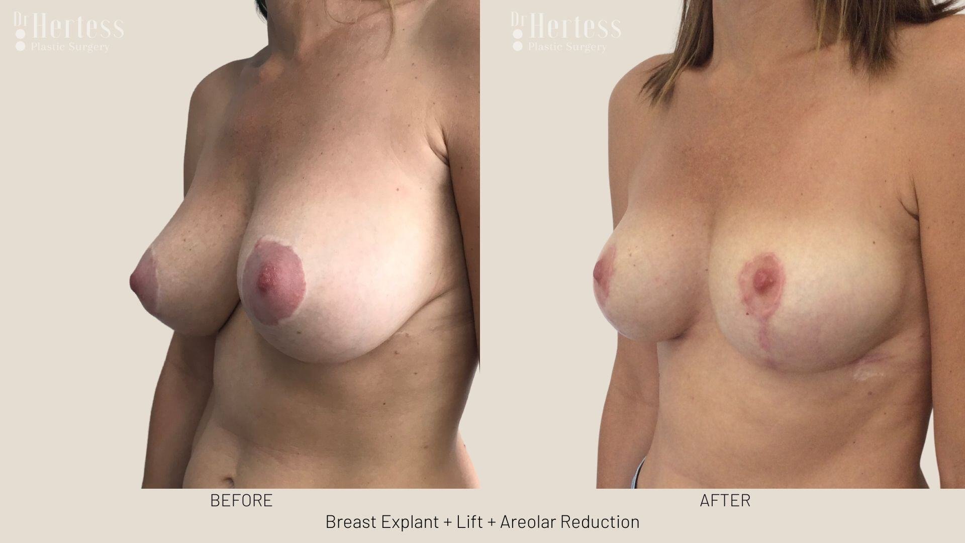 breast explant and lift photos