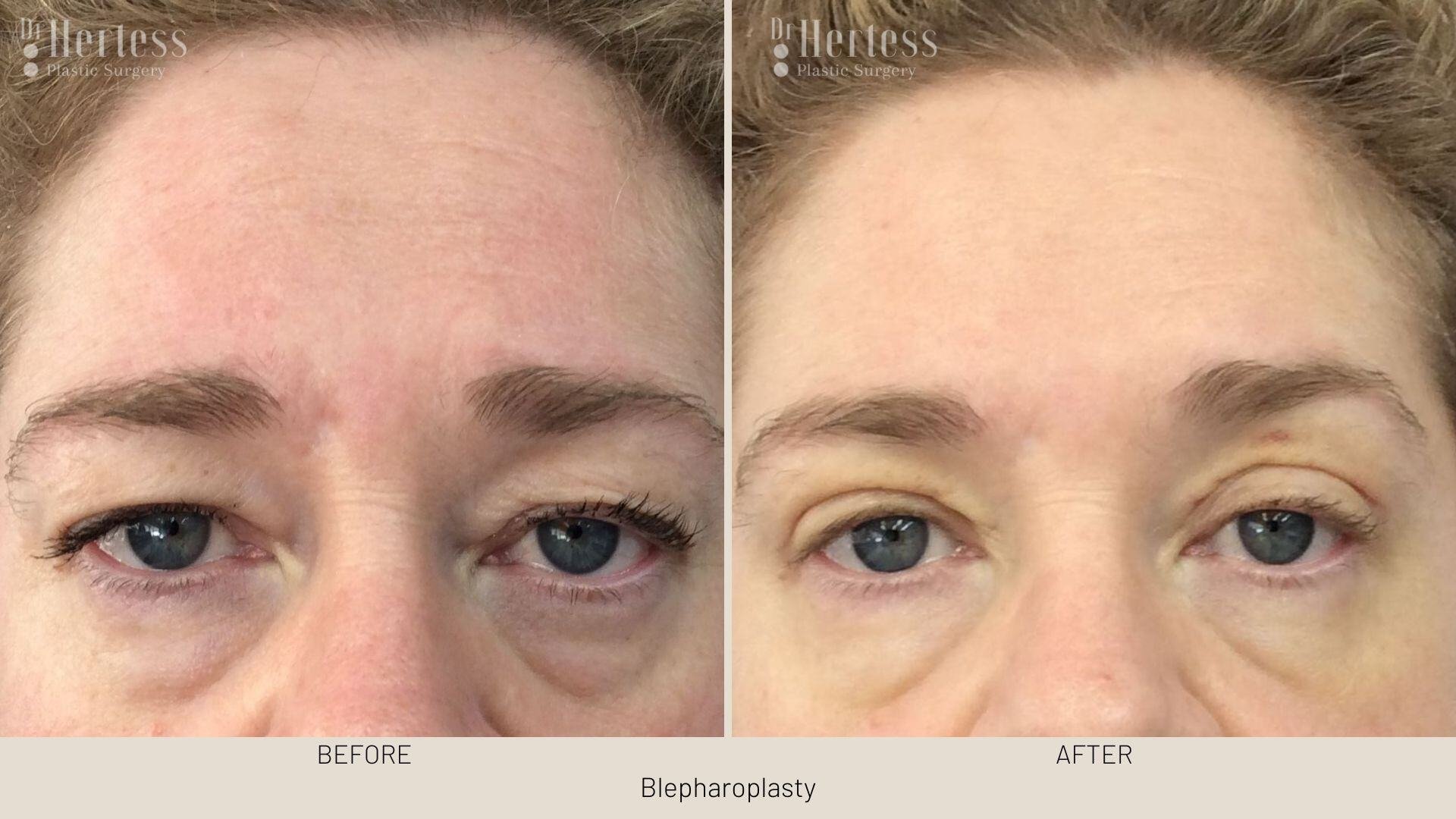 eyelid surgery before and after