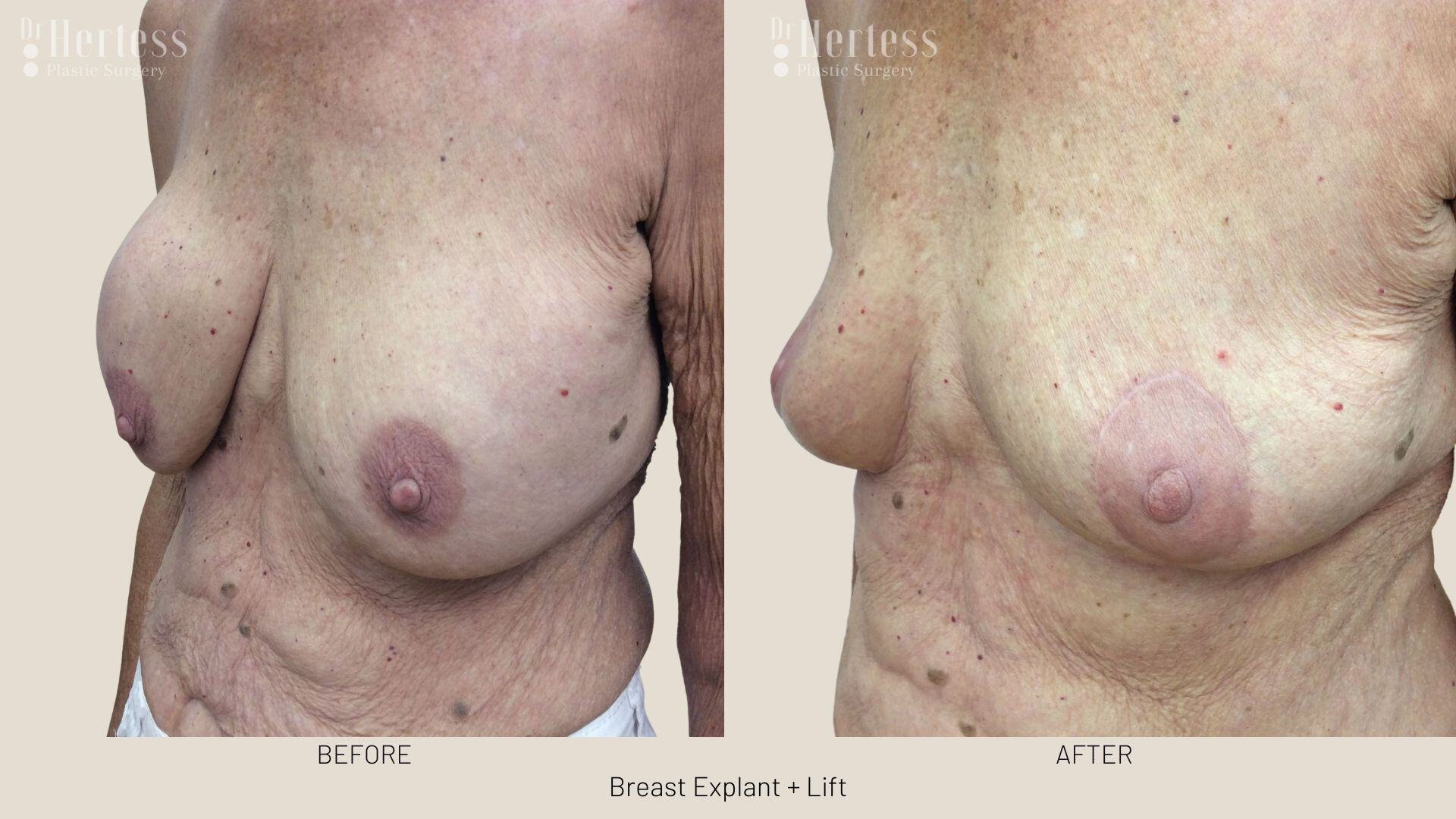 breast explant and lift photos
