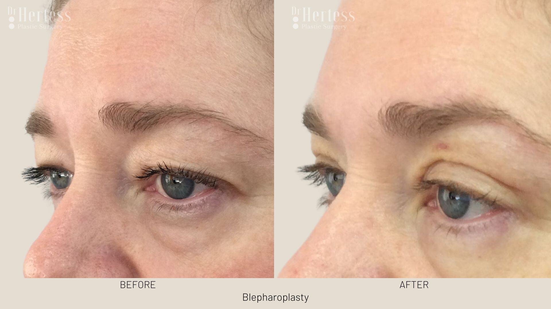 eyelid surgery before and after