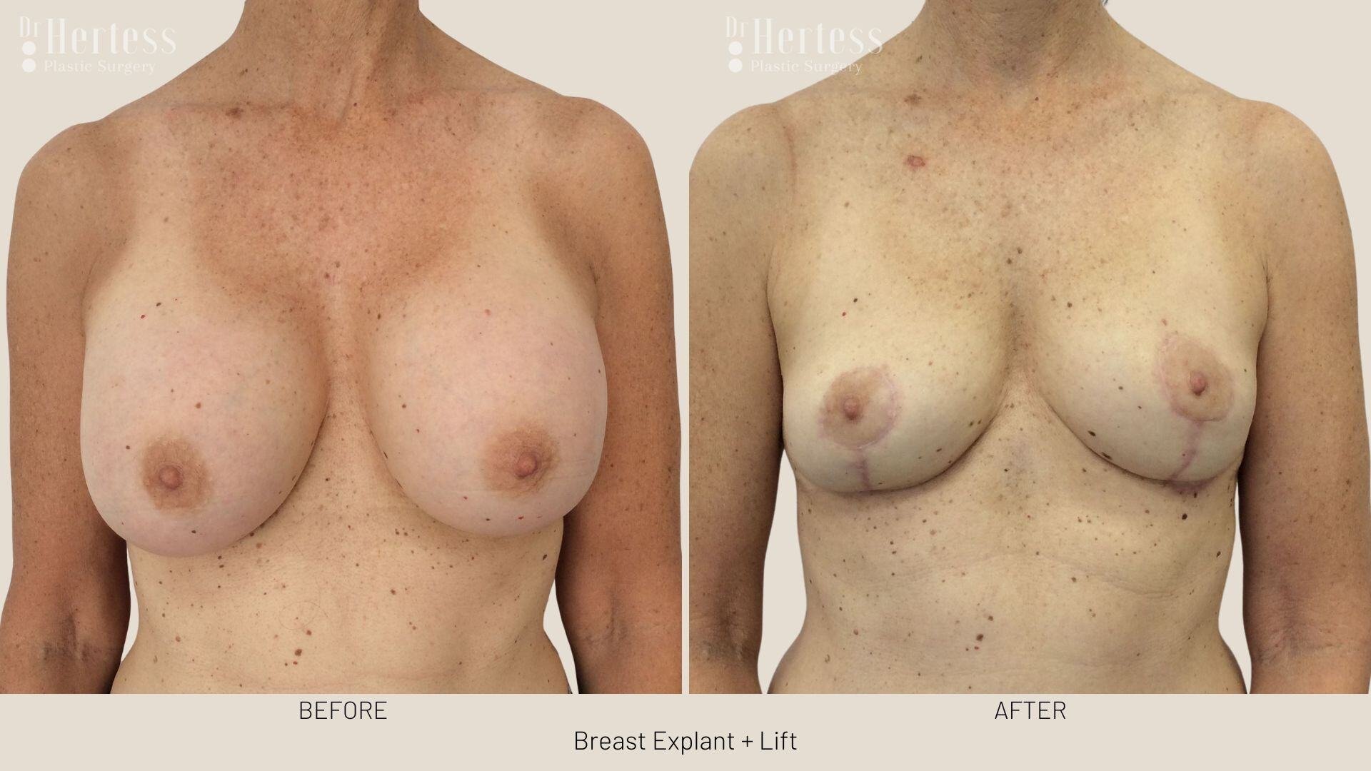 breast explant and lift photos