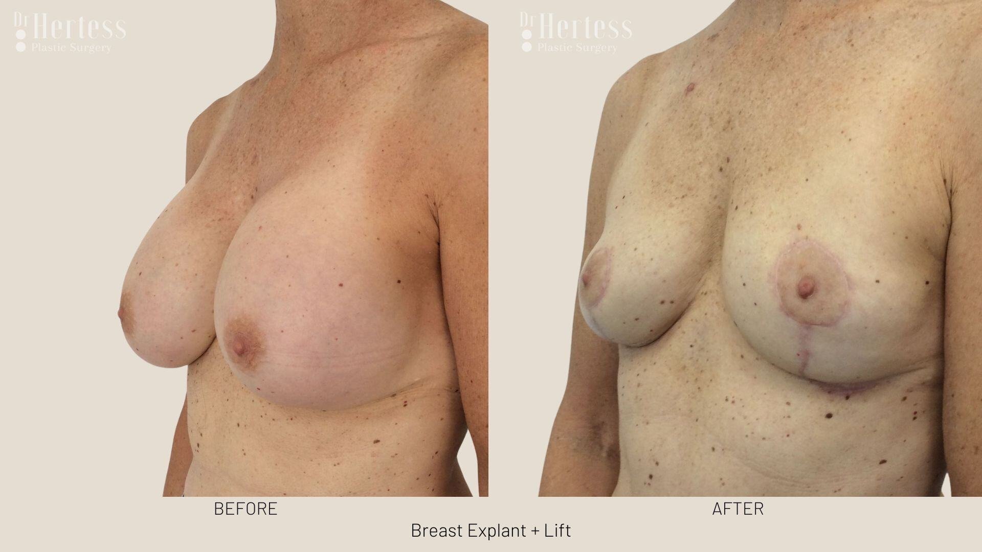 breast explant and lift photos