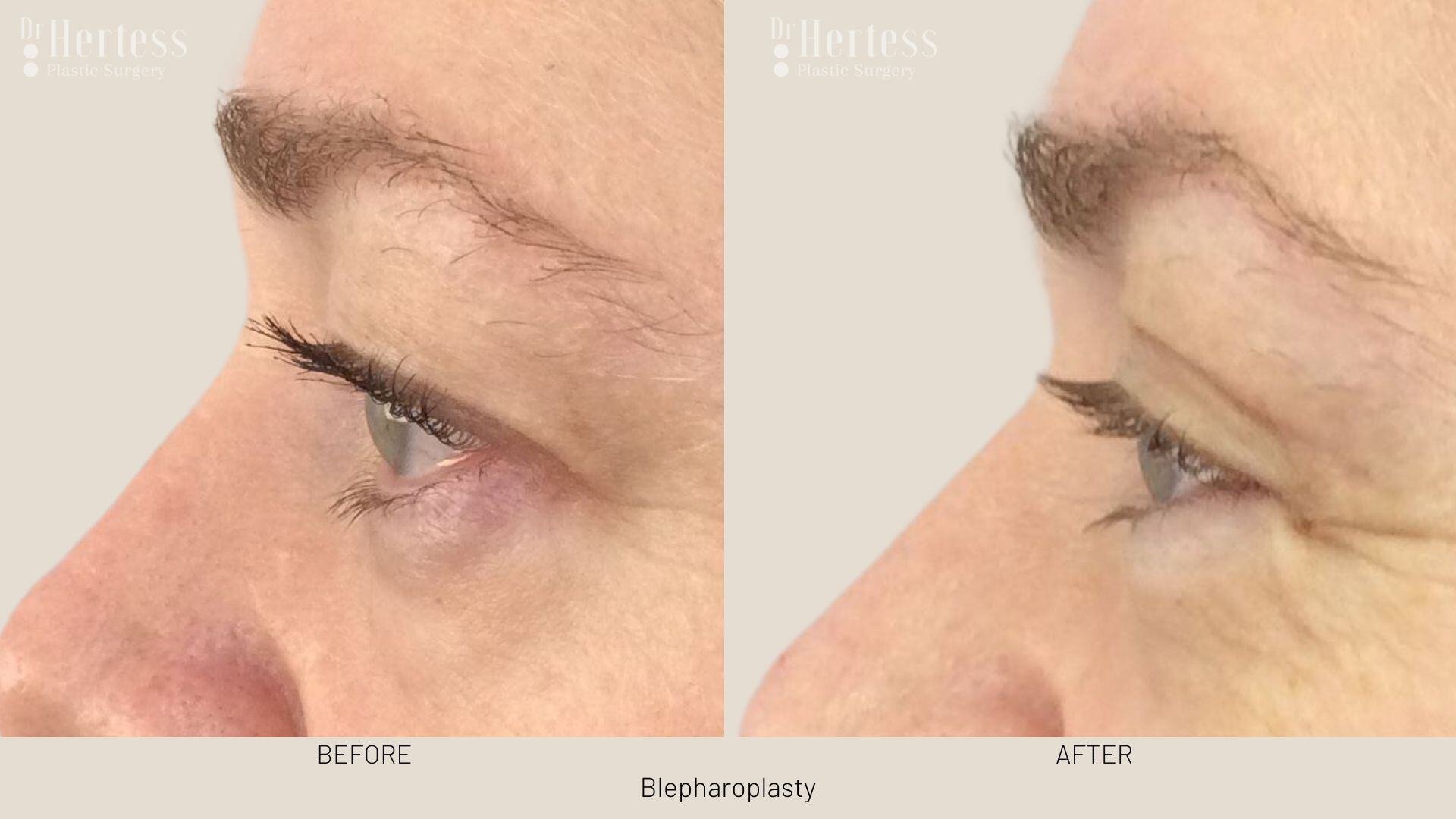 eyelid surgery before and after