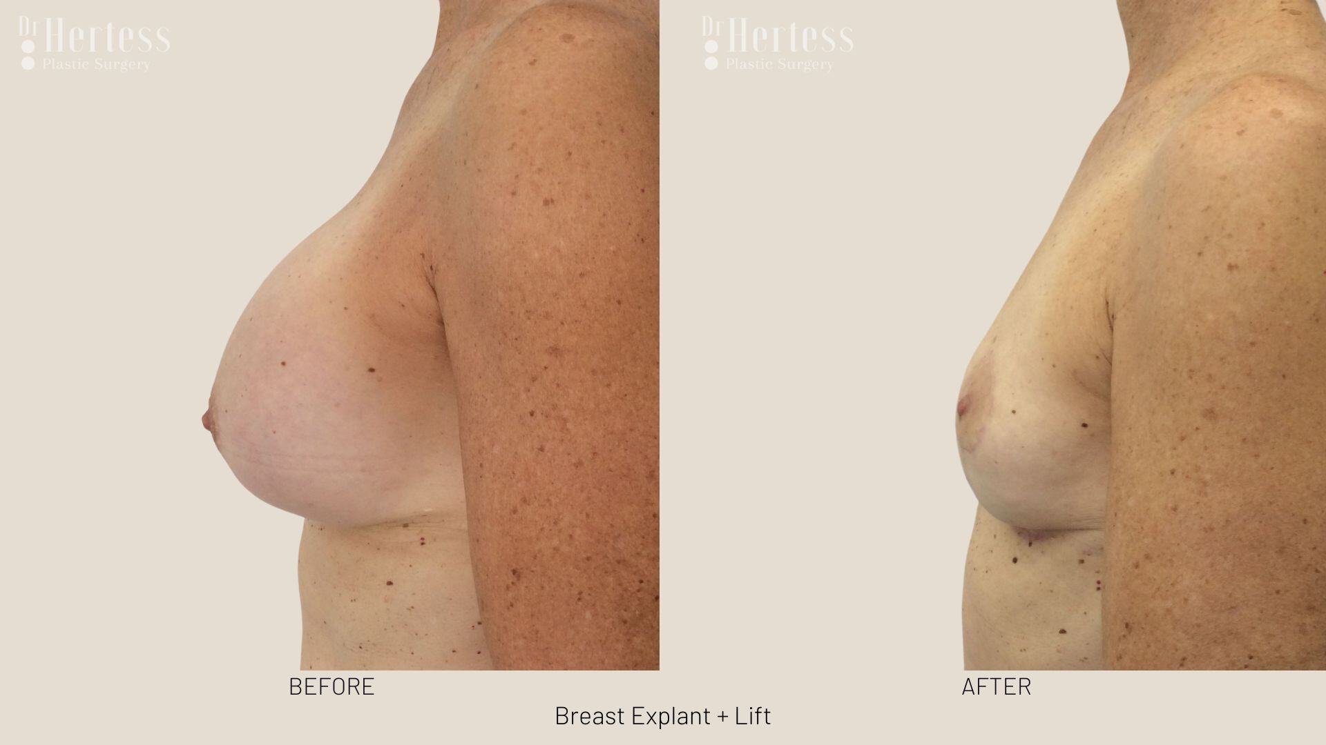 breast explant and lift photos