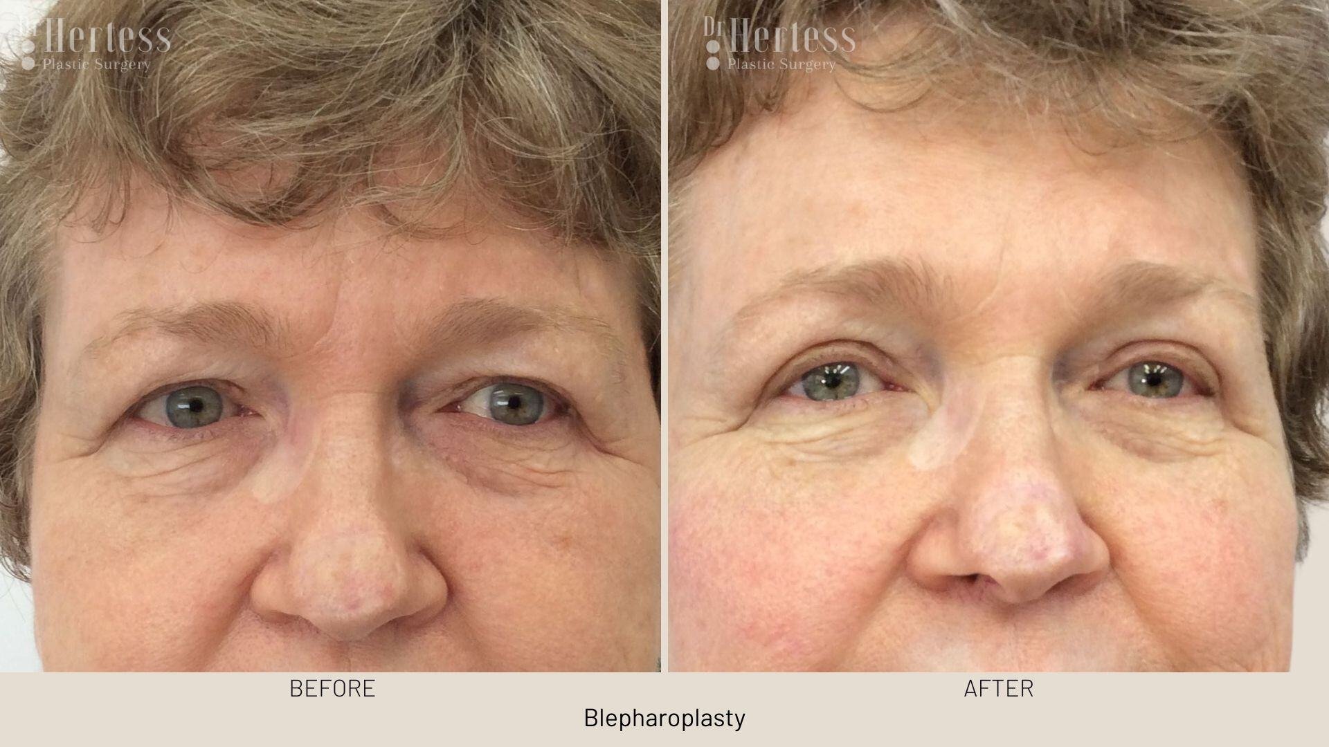 eyelid surgery before and after