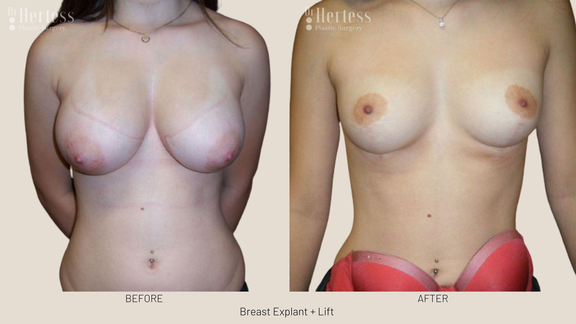 breast explant and lift photos