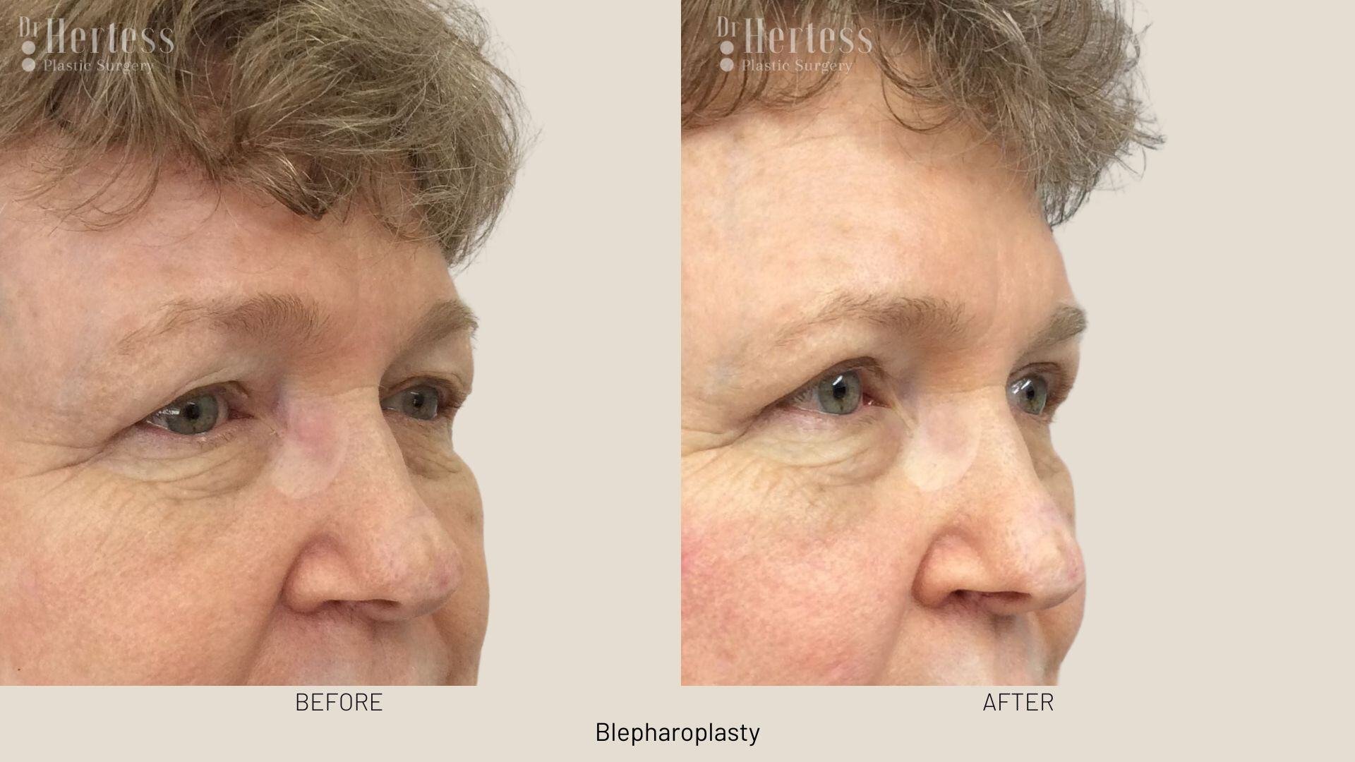 eyelid surgery before and after