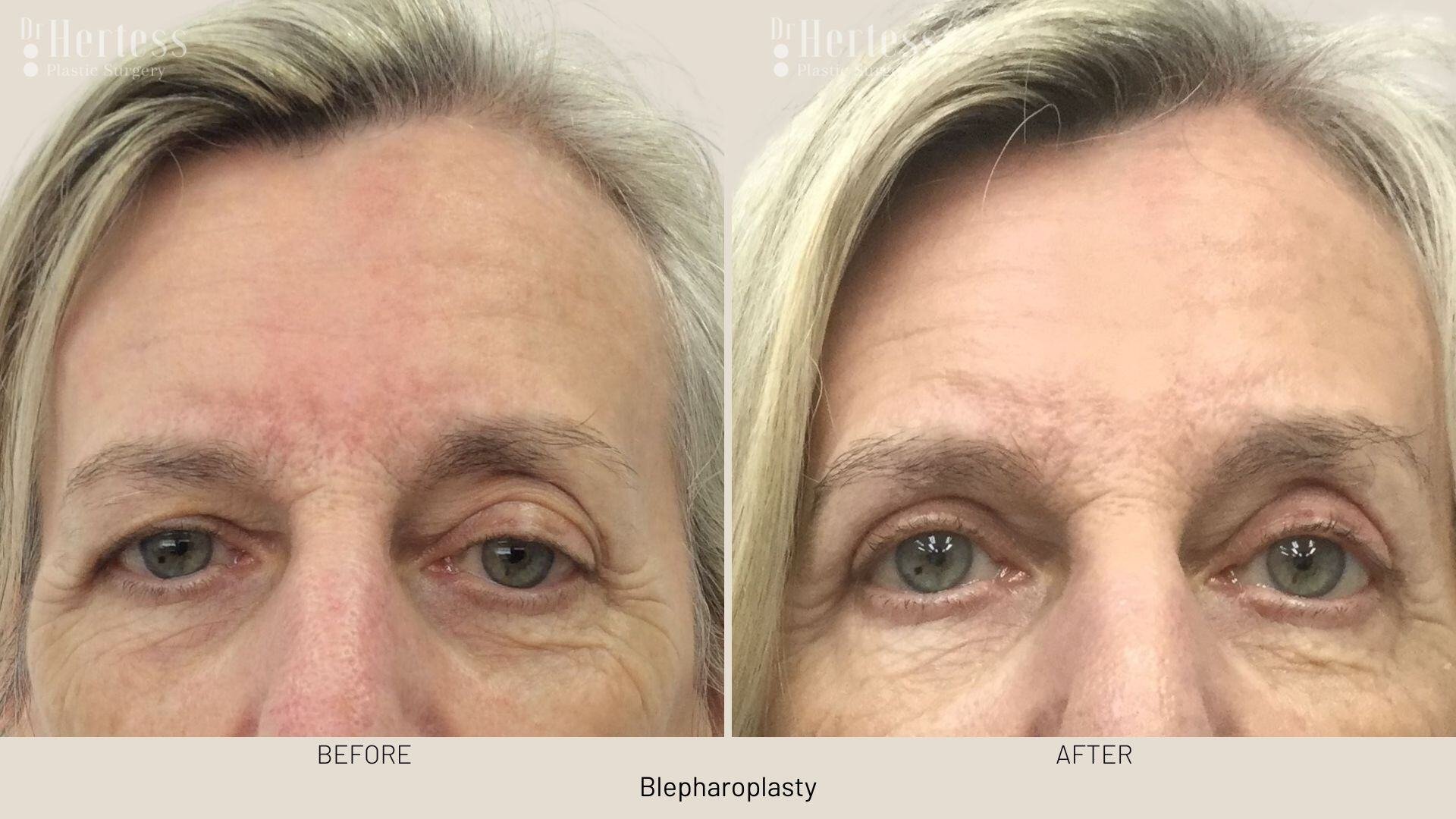 eyelid surgery before and after