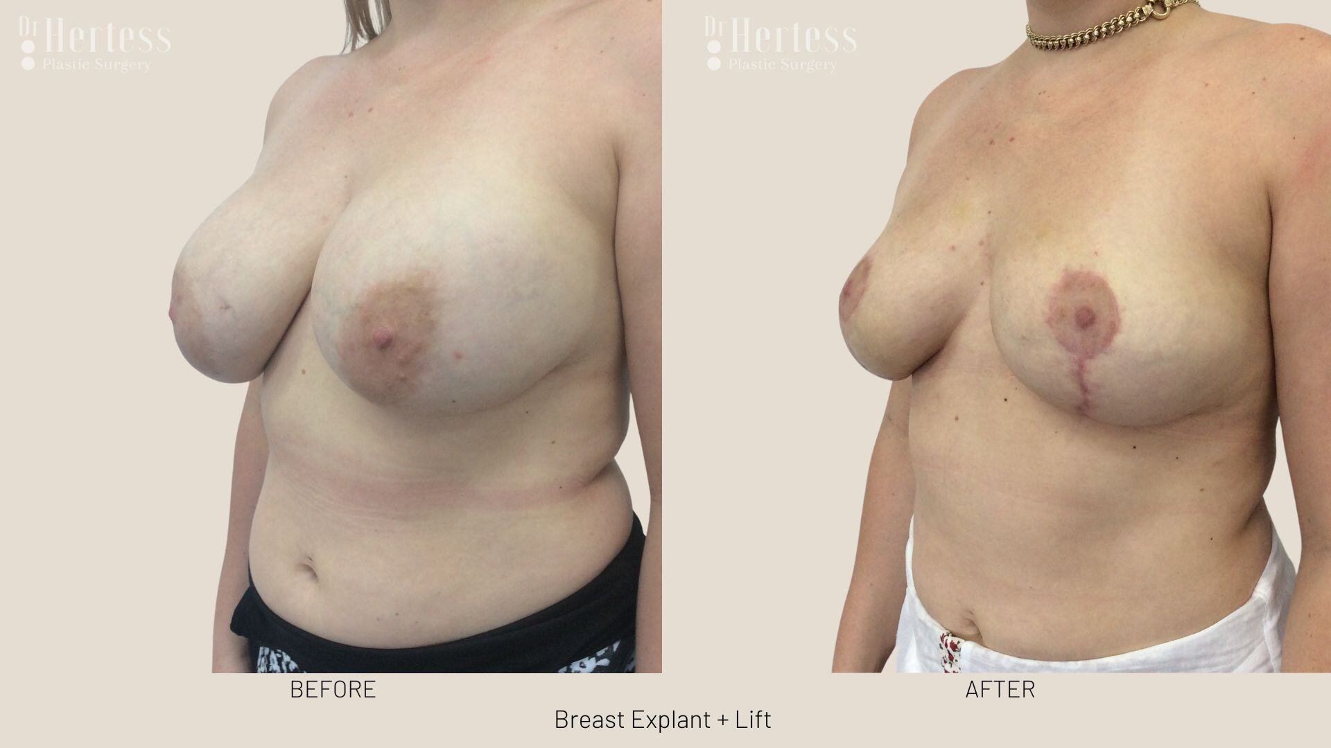 breast explant and lift photos