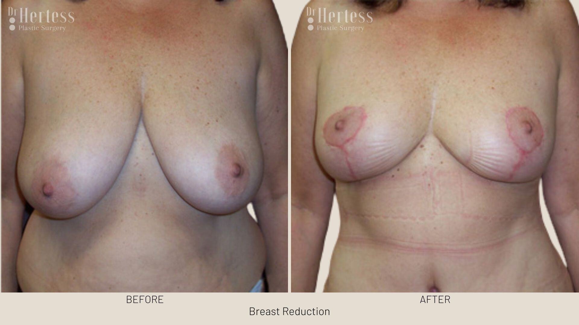 breast reduction before and after