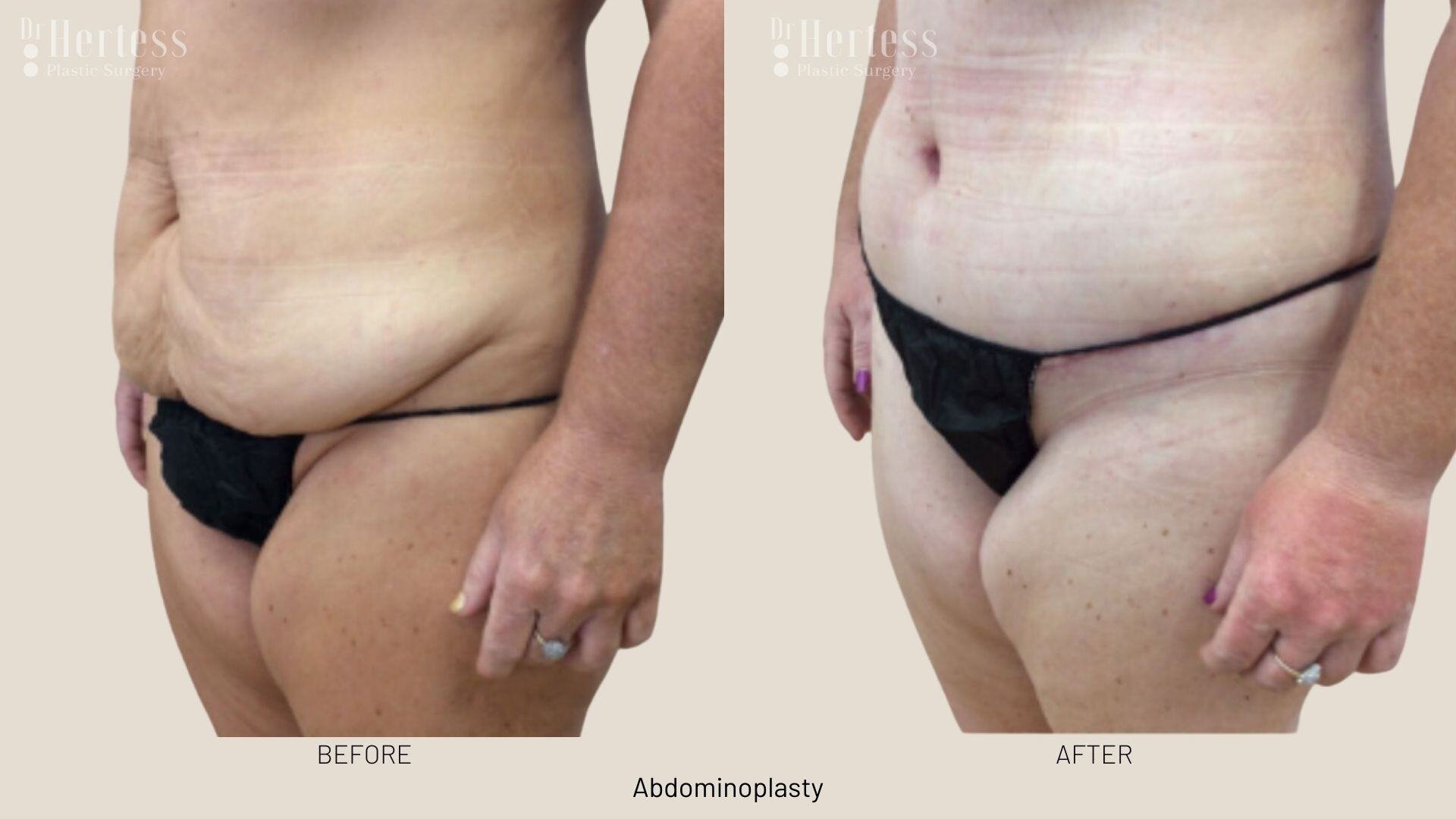 abdominoplasty before and after photos