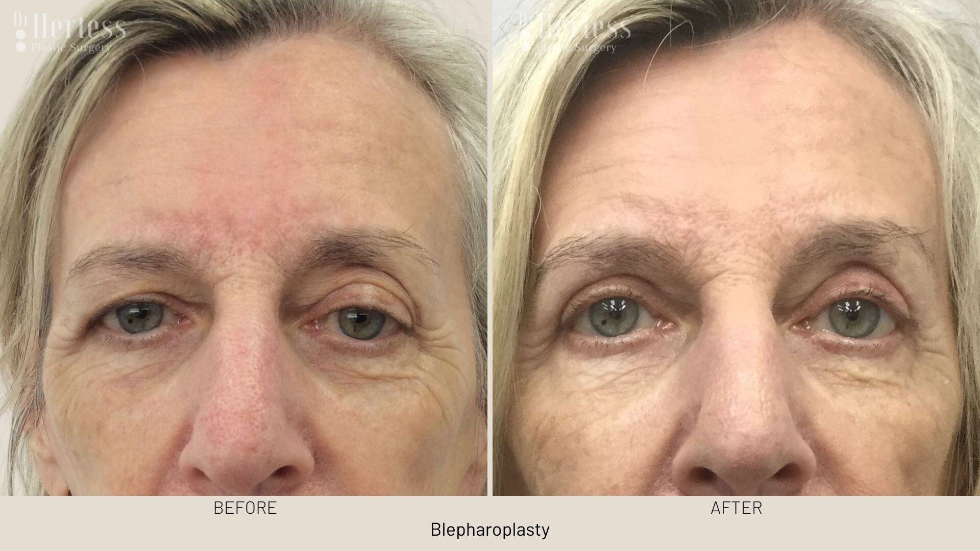 eyelid surgery before and after