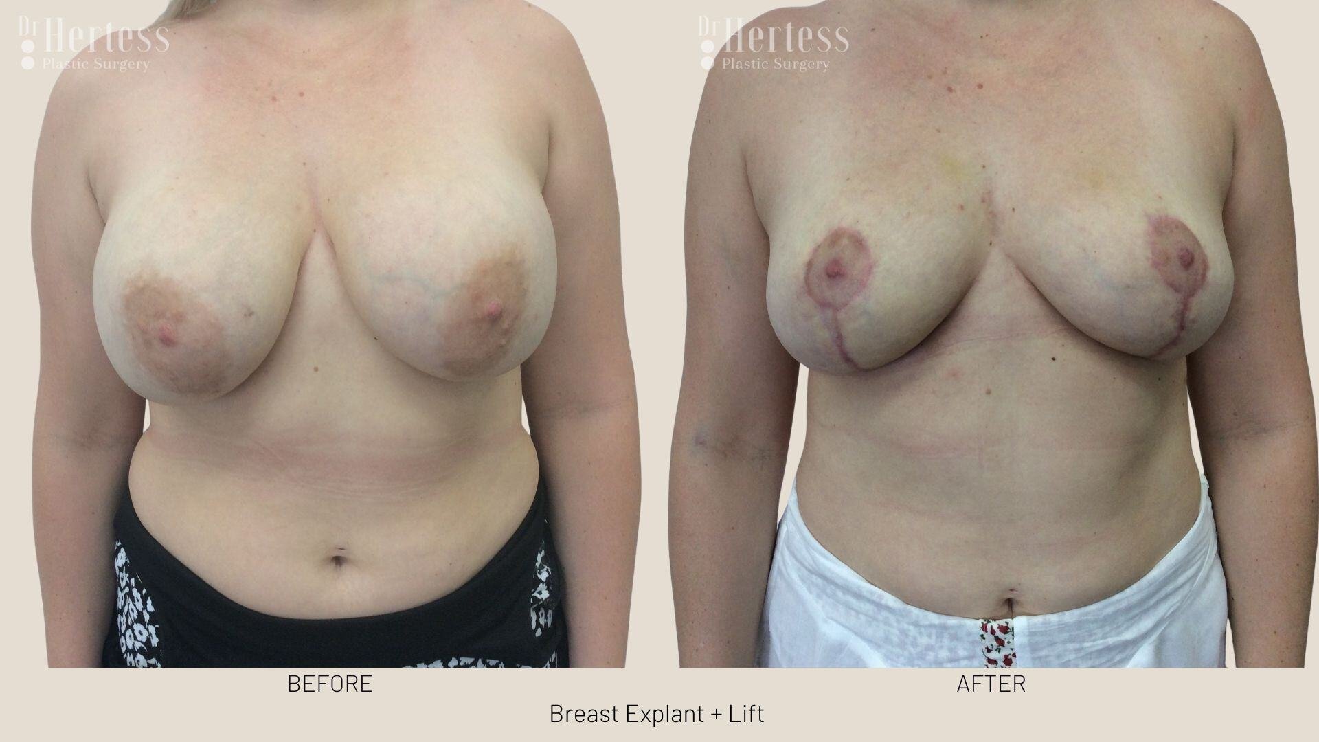 breast explant and lift photos
