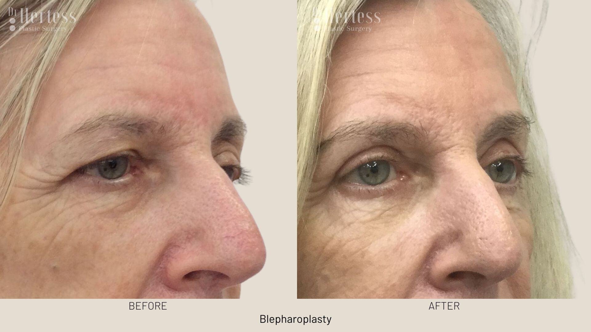 eyelid surgery before and after