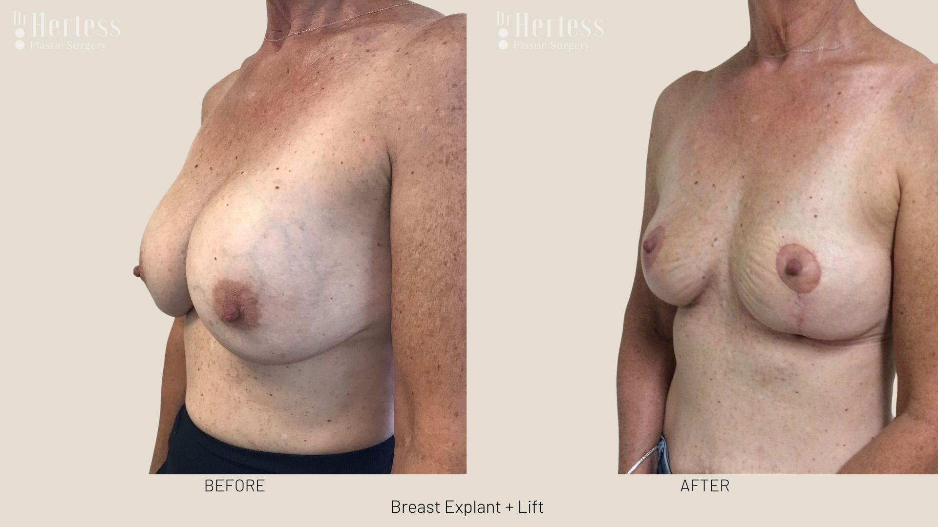 breast explant and lift photos