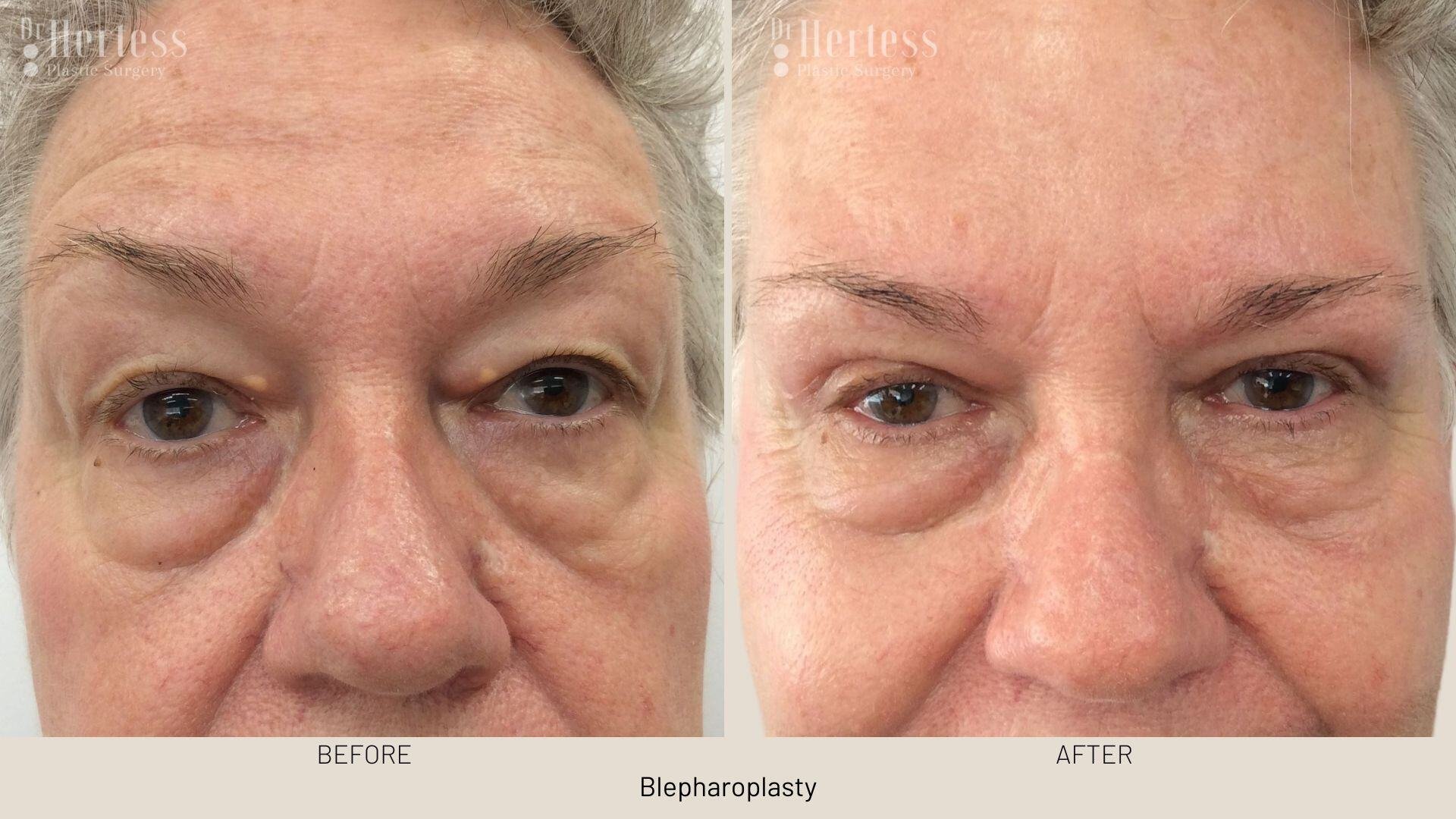 eyelid surgery before and after