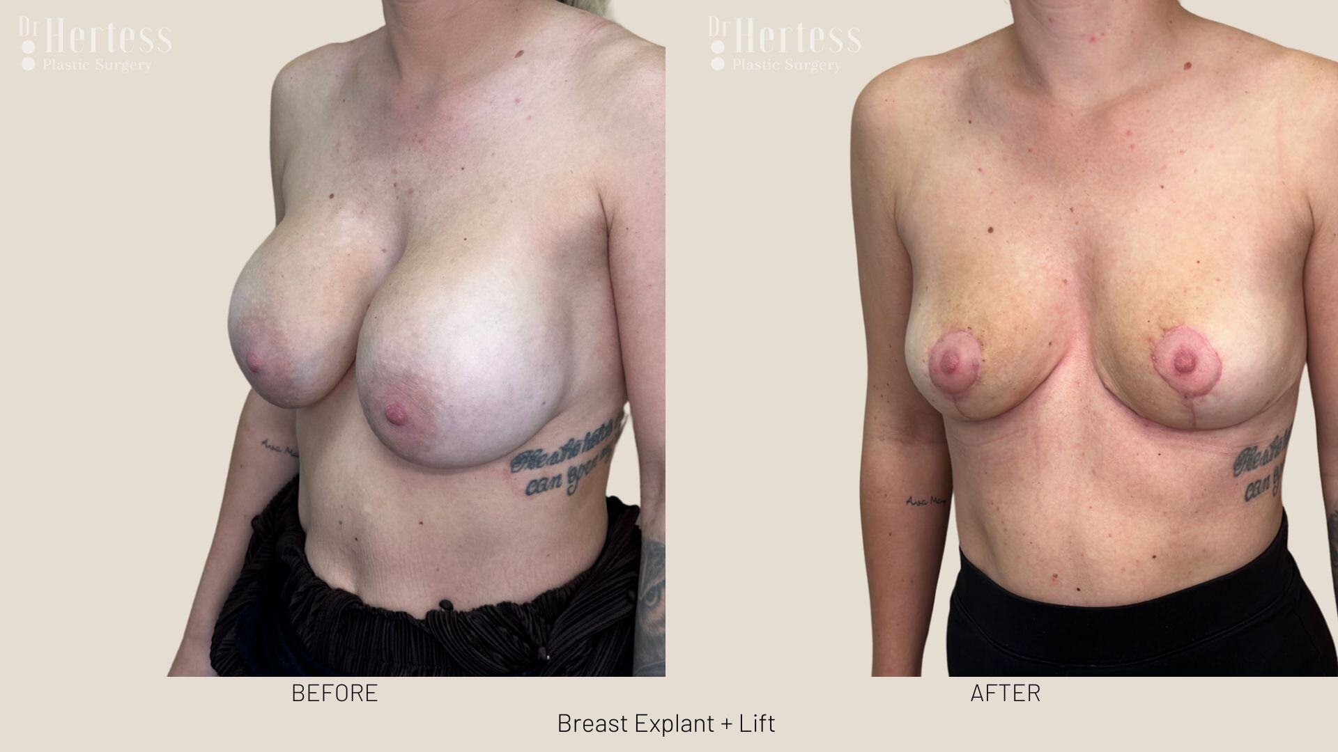 breast explant and lift photos